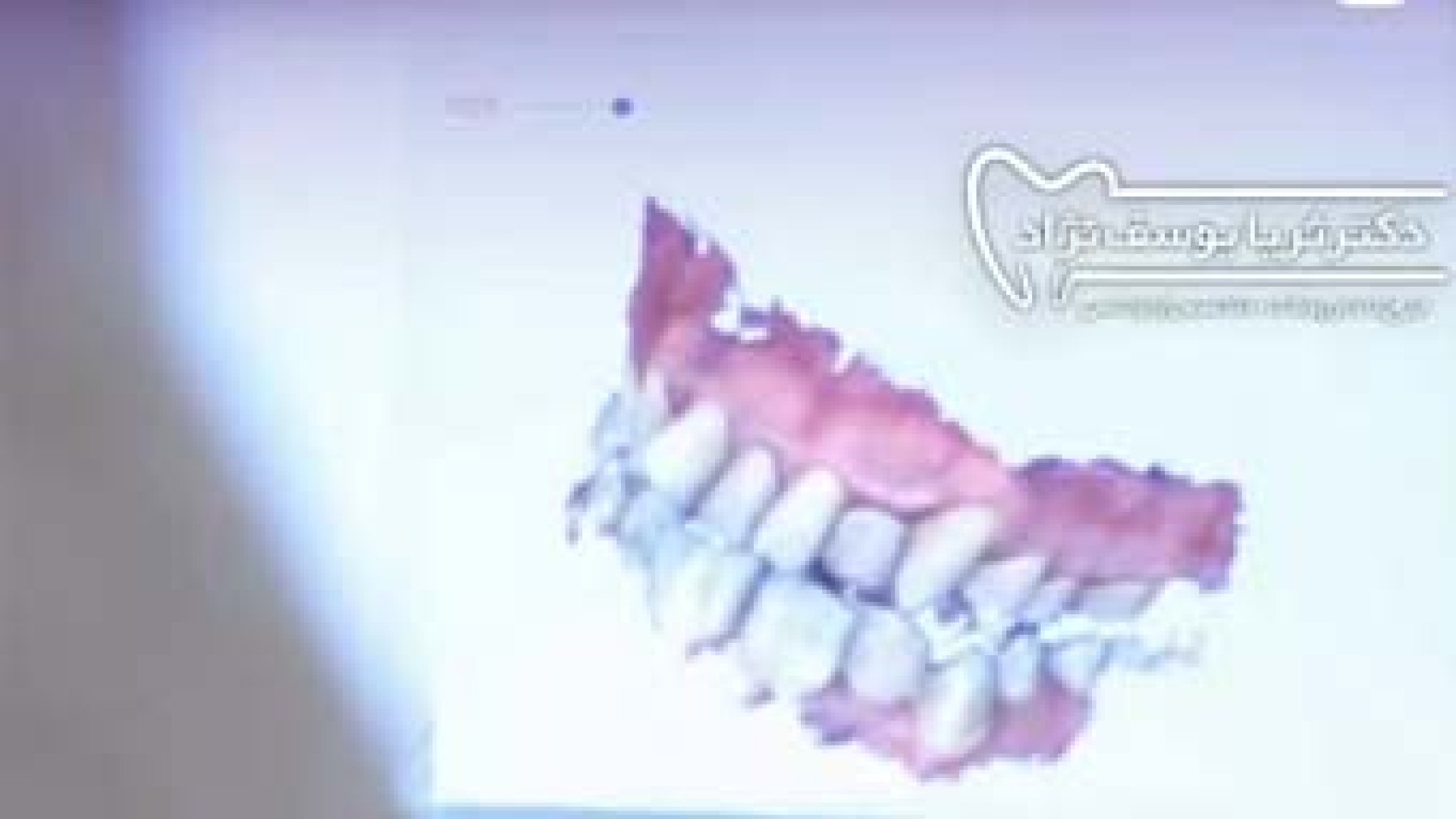 درمان ارتودنسی ثابت توسط دکتر ثریا یوسف نژاد دکتر ثریا یوسف نژاد متخصص ارتودنسی بابل