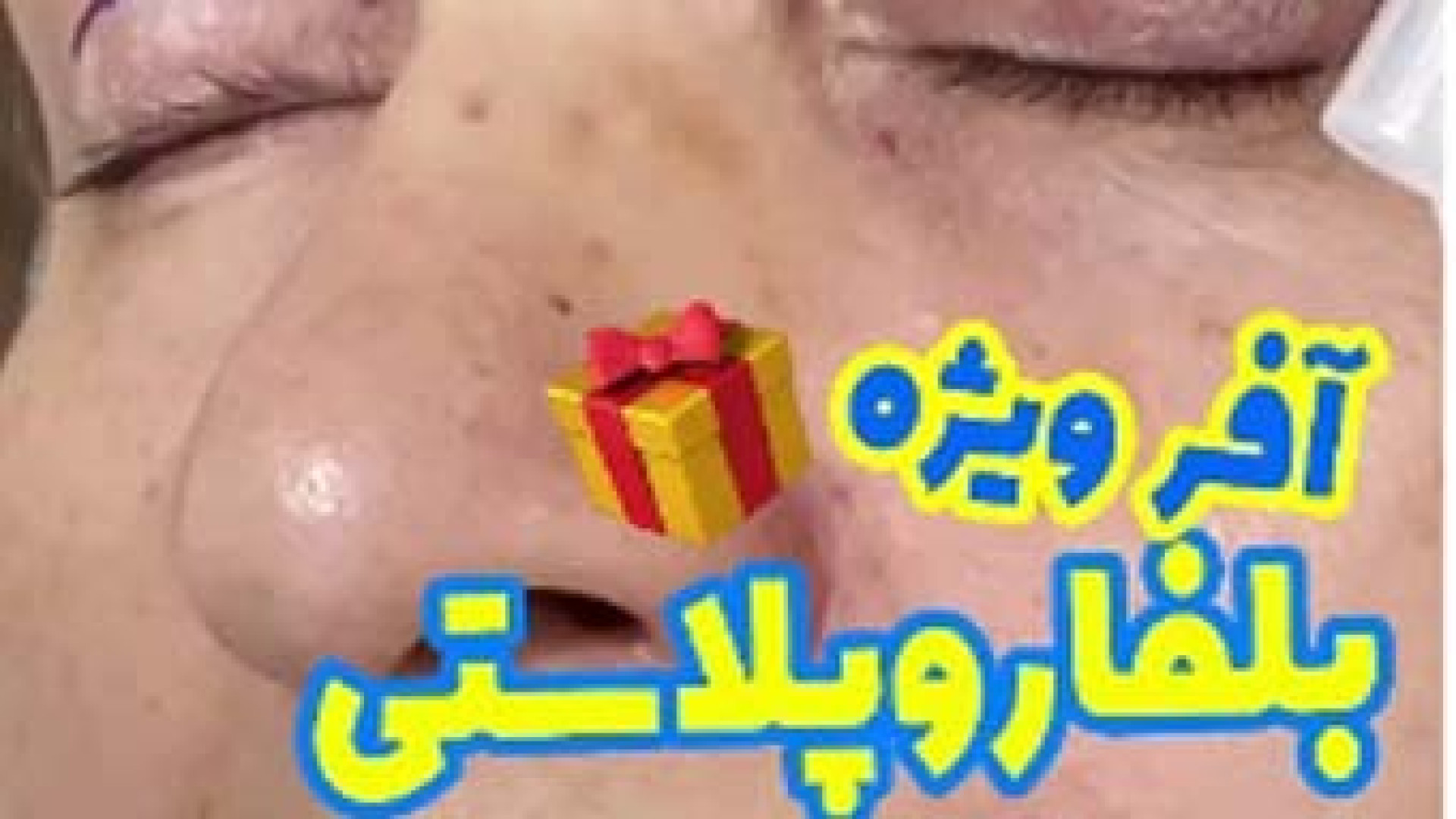بلفاروپلاستی با بیحسی | دکتر شادی جوادی لیفت صورت