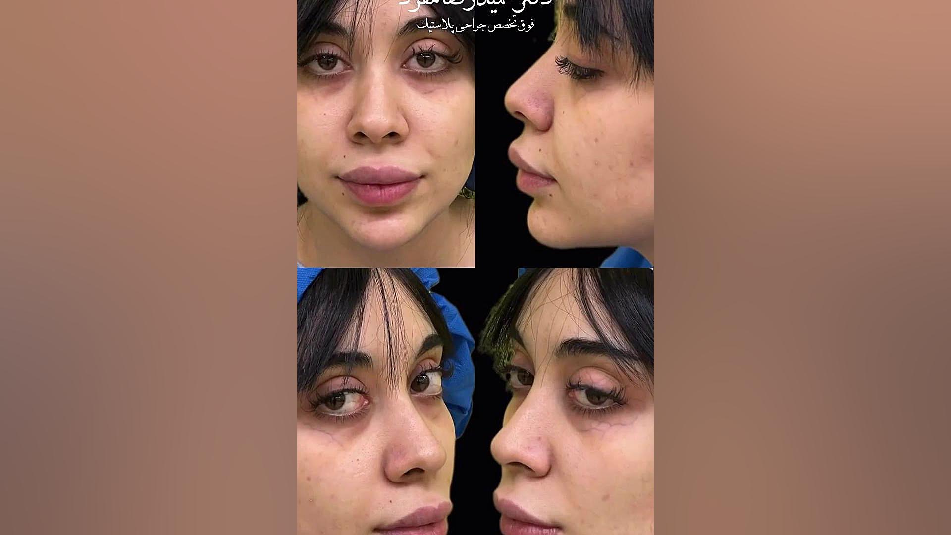 هشت ماه از جراحی بینی ملیکا جان دختر خوبمون میگذره دکتر حمیدرضا مفرد
