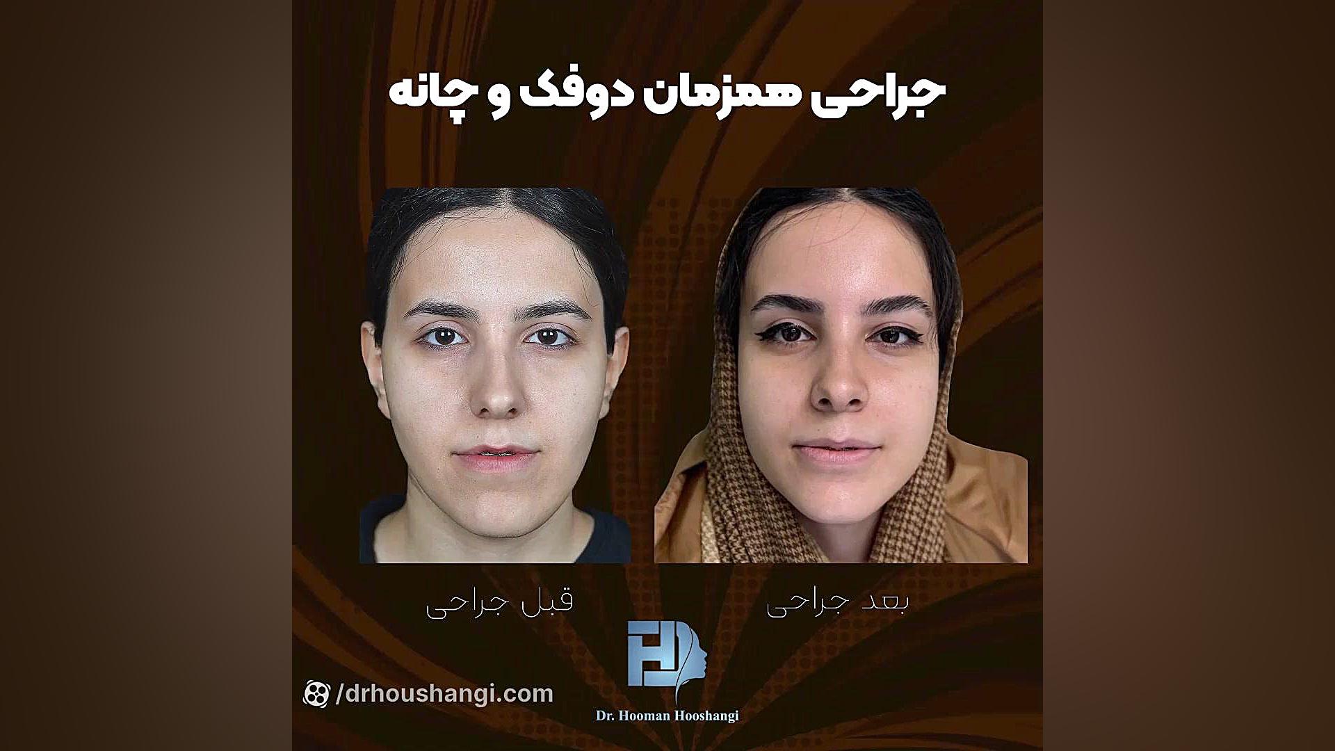 قبل و بعد از جراحی فک درمان سلول‌های بنیادی