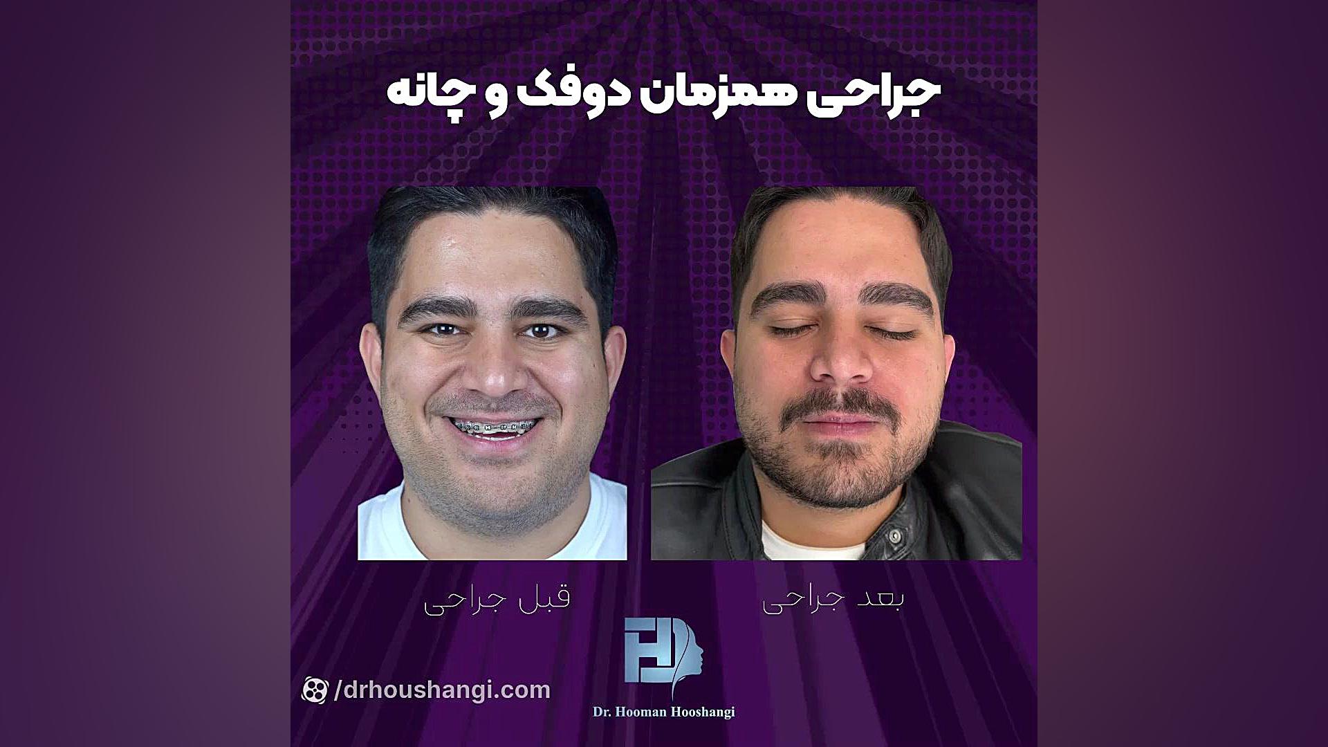 قبل و بعد از جراحی فک عمل زیبایی