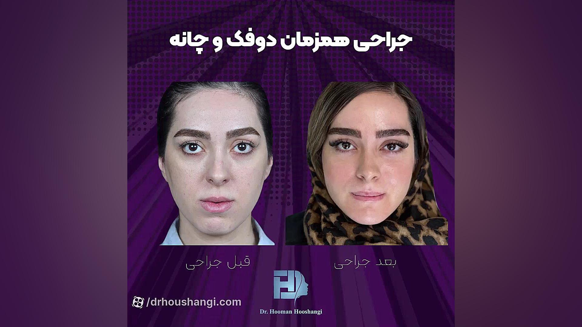 جراحی فک و صورت قبل و بعد هایپرپاراتیروئیدیسم