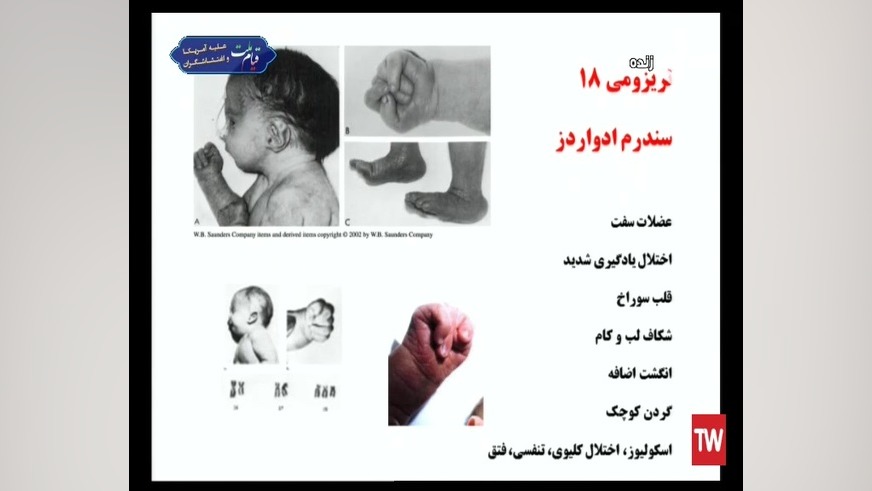 سندرم ادوارد یا تریزومی 18 چیست ؟ کلینیک مو
