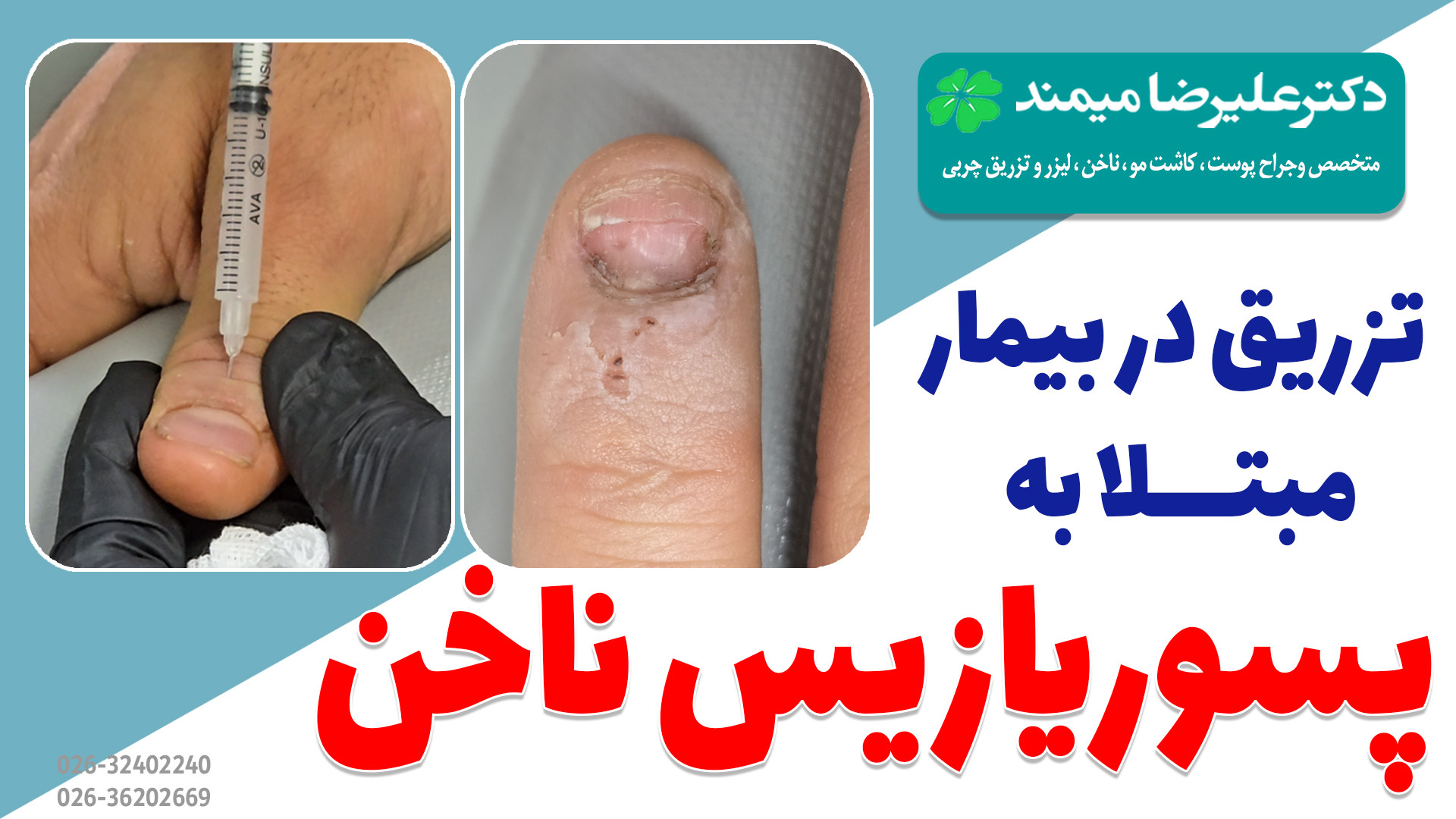 تزریق به ناخن مبتلا به پسوریازیس ناخن دکتر میمند متخصص پوست کرج کیهان کلهر