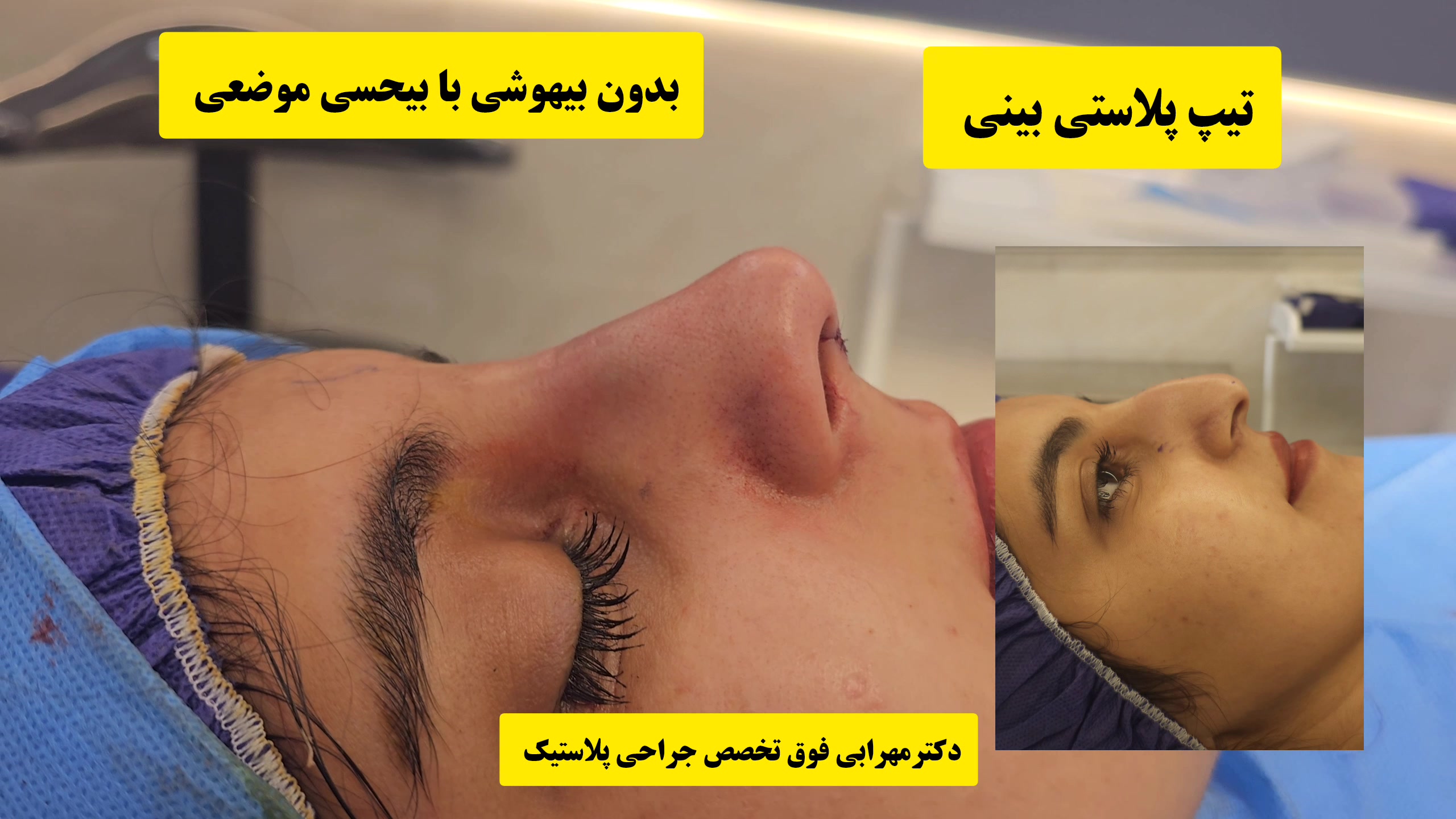 تیپ پلاستی بینی بدون بیهوشی با بیحسی موضعی در شیراز دکتر محمد مهدی مهرابی جراح پلاستیک و زیبایی