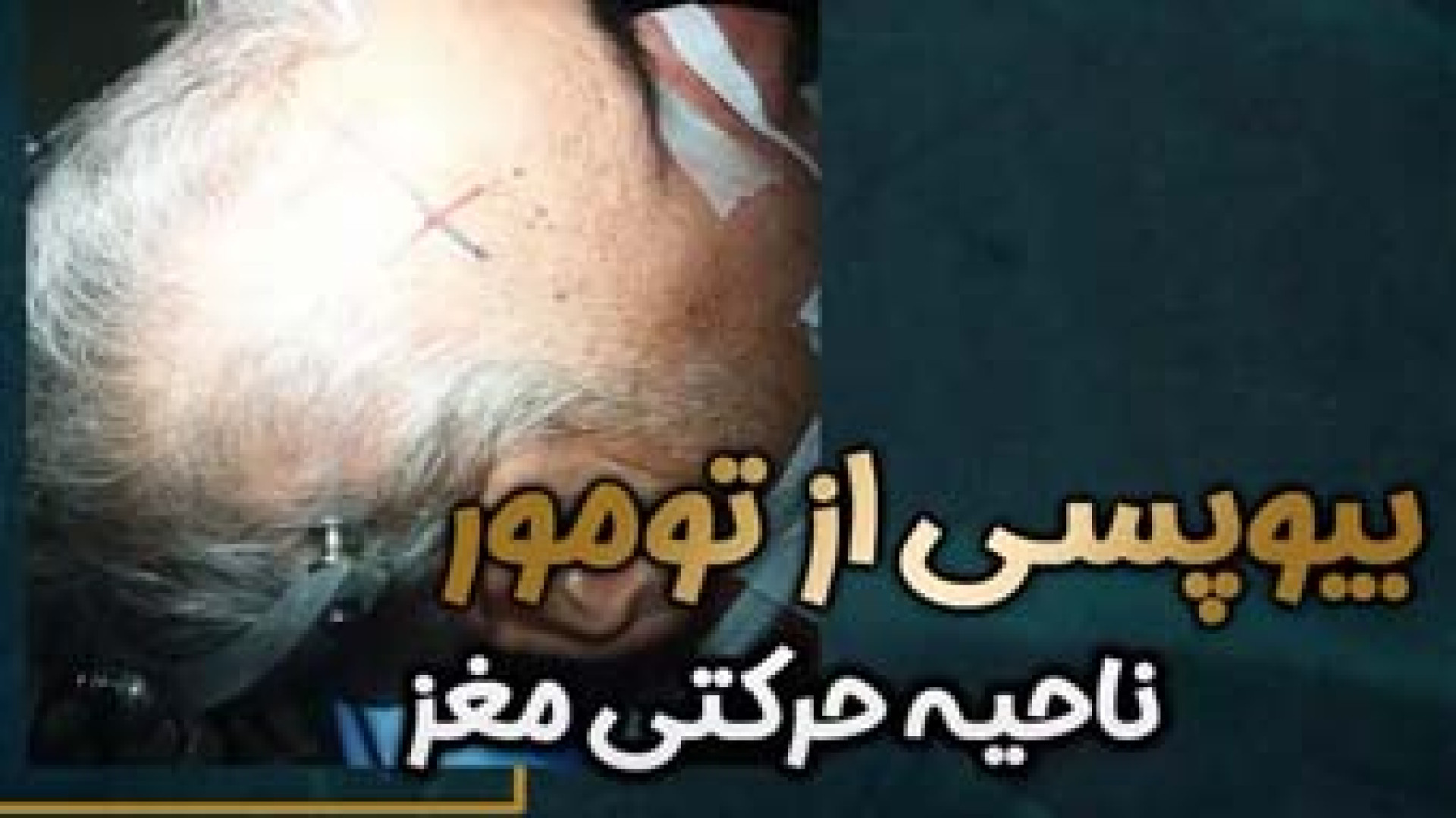 تومور ناحیه حرکتی مغز | دکتر امین جهانبخشی پاکسازی پوست