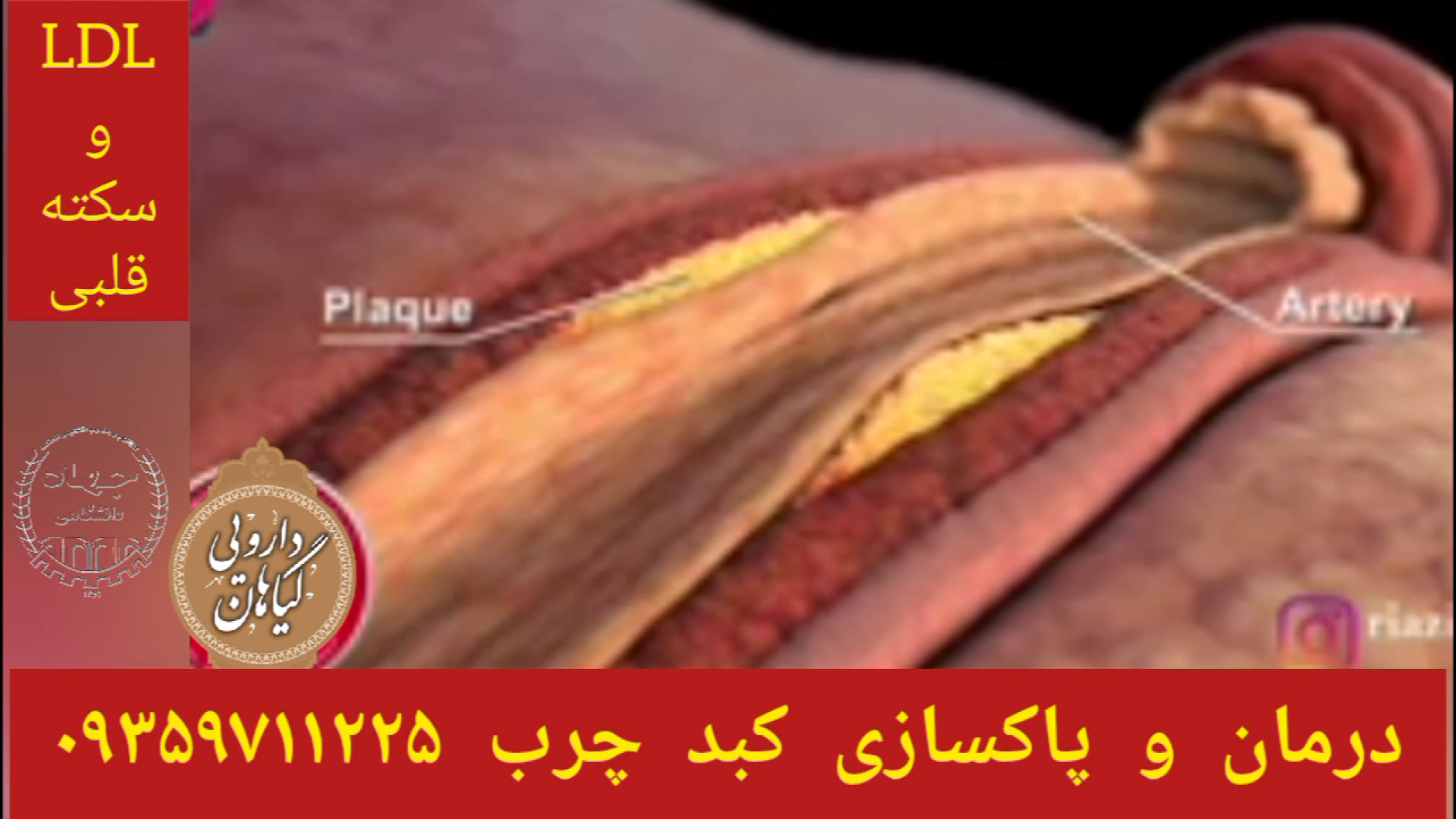 LDL خون درمان و پاکسازی کبدچرب توسط شاگردان حکیم خیراندیش ۰۹۳۵۹۷۱۱۲۲۵ پیلینگ شیمیایی
