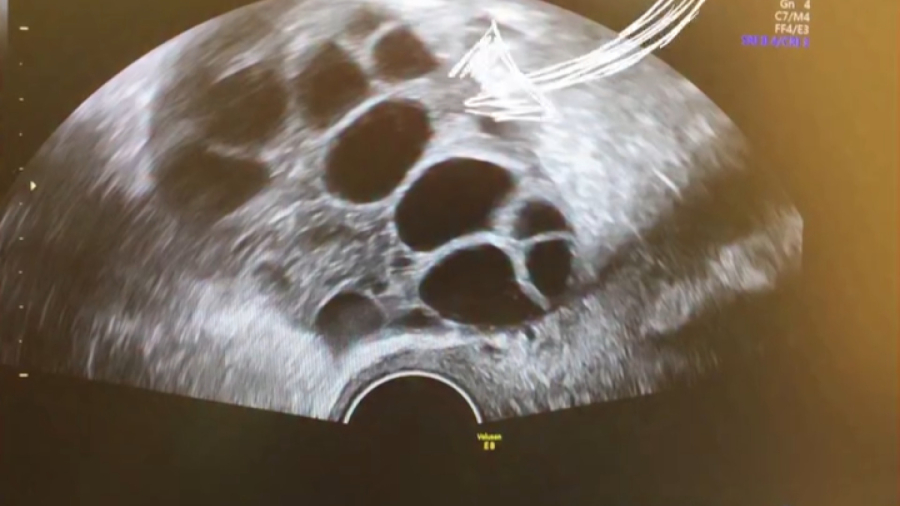 فیلم آندومتریوز تخمدان