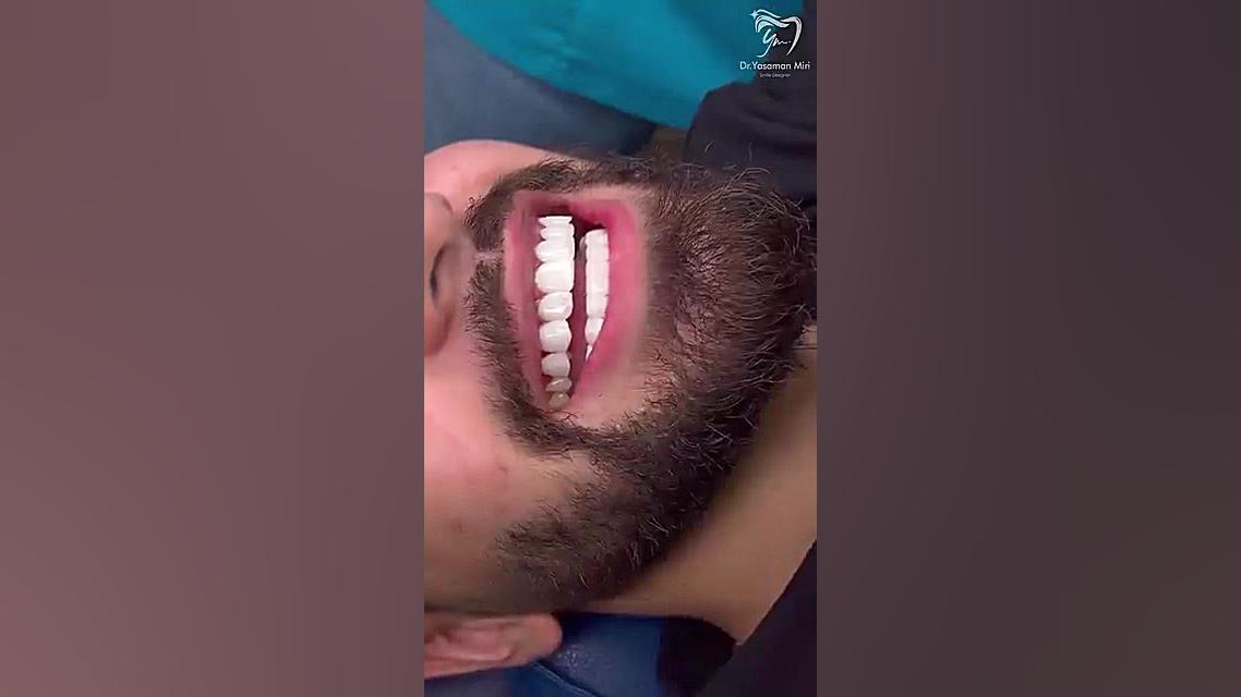 حداقل آسیب به ساختار دندان با کامپوزیت ونیر جراحی پف زیر چشم