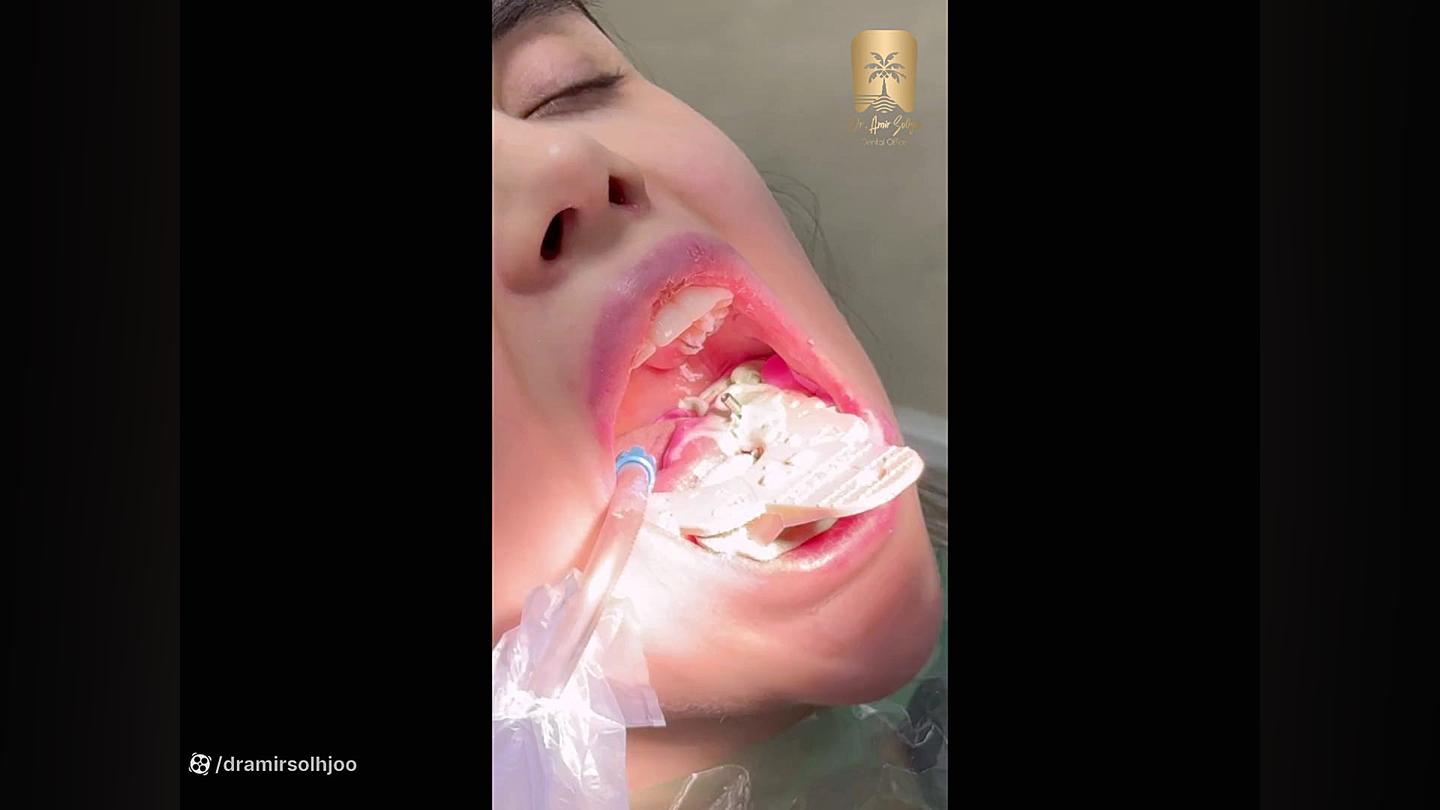روکش ایمپلنت حرفه ای در دندانپزشکی لاکچری دکتر امیر صلح جو دندانپزشکی دکتر امیر صلح جو