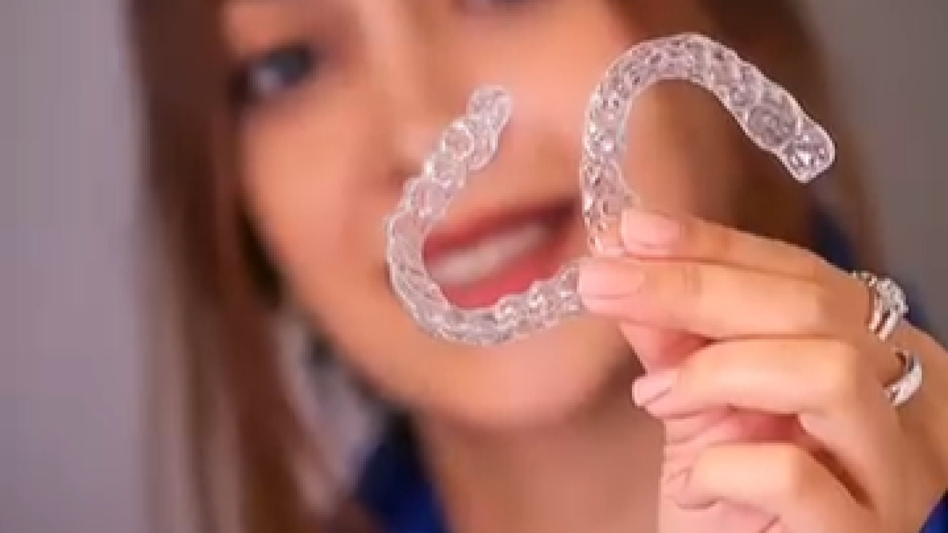 مراحل نصب ارتودنسی نامرئی الاینر دکتر فرزاد ناصری متخصص ارتودنسی در اصفهان