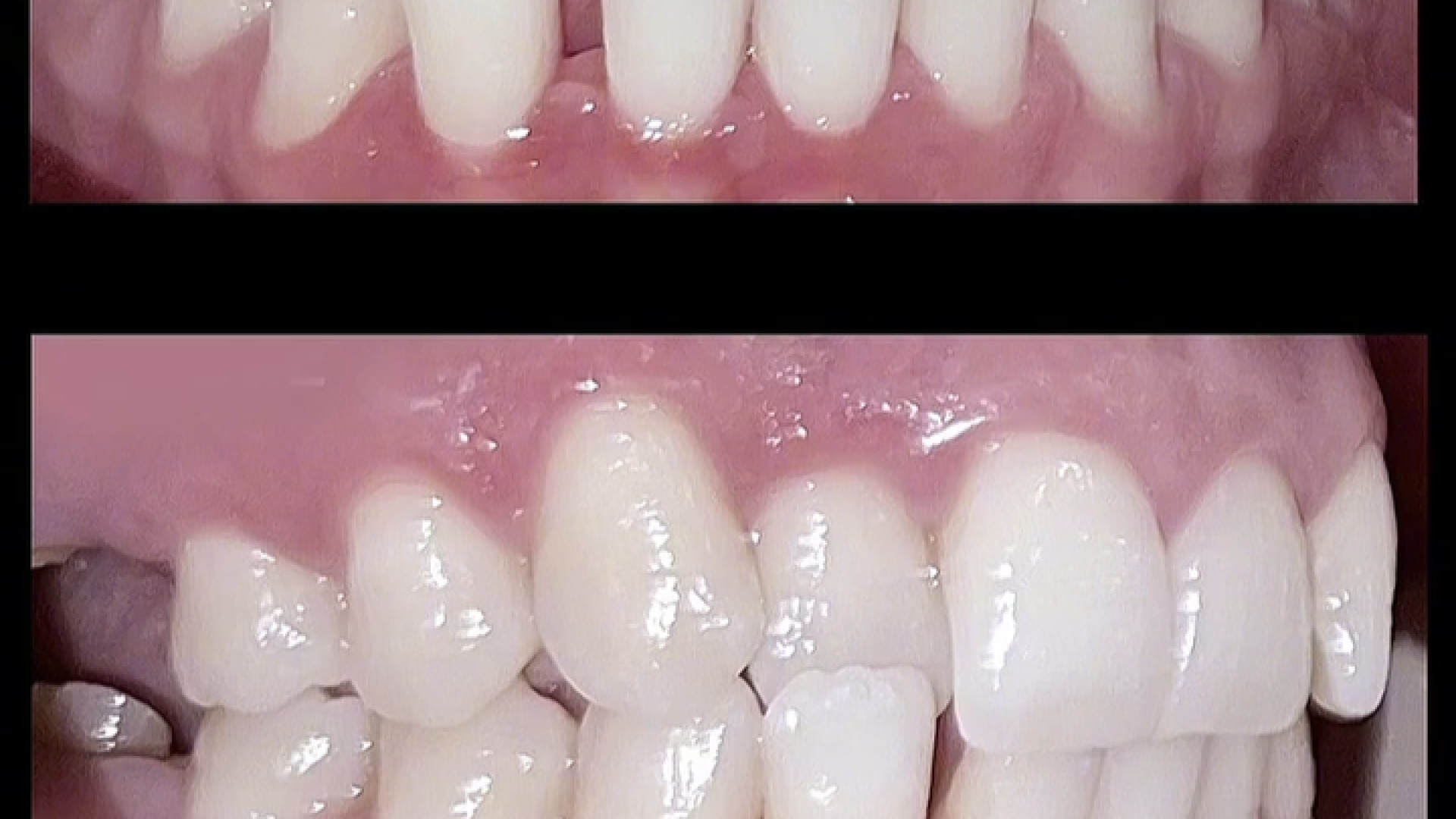 ارتودنسی دندان برای اصلاح بی نظمی شدید دندان ها دکتر فرزاد ناصری متخصص ارتودنسی در اصفهان