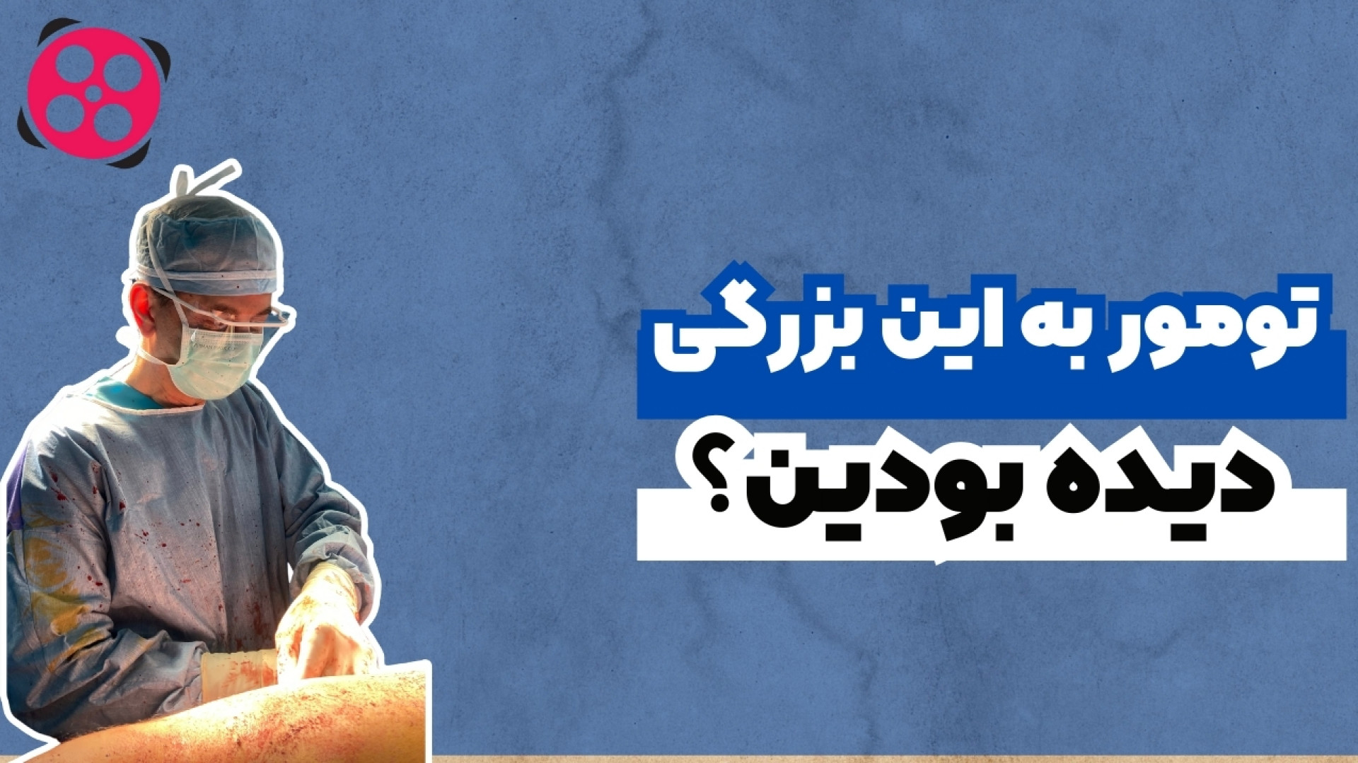 تومور به این بزرگی دیده بودین؟؟ دکتر محمود جعفر بیگلو