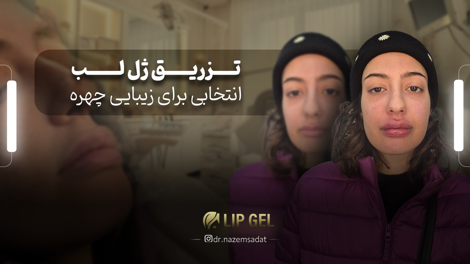 تزریق ژل لب، انتخابی برای زیبایی چهره | دکتر منیرالدین ناظم السادات دکتر سید منیرالدین ناظم السادات