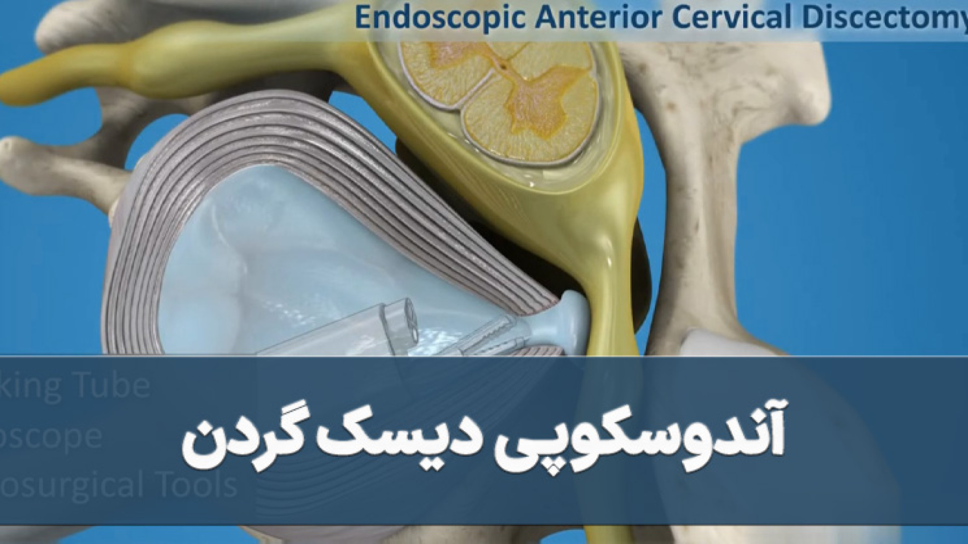 آندوسکوپی دیسک گردن لمینت
