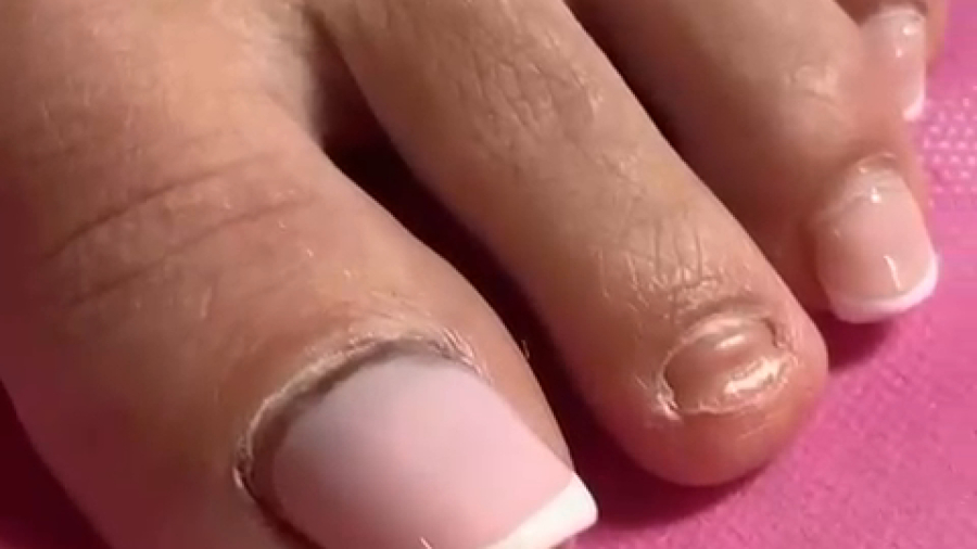 چرا ناخن هماتوم میشود ؟؟؟؟