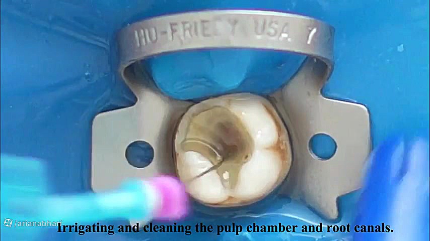 آموزش کامل پر کردن دندان پوسیده هایپررفلکسی