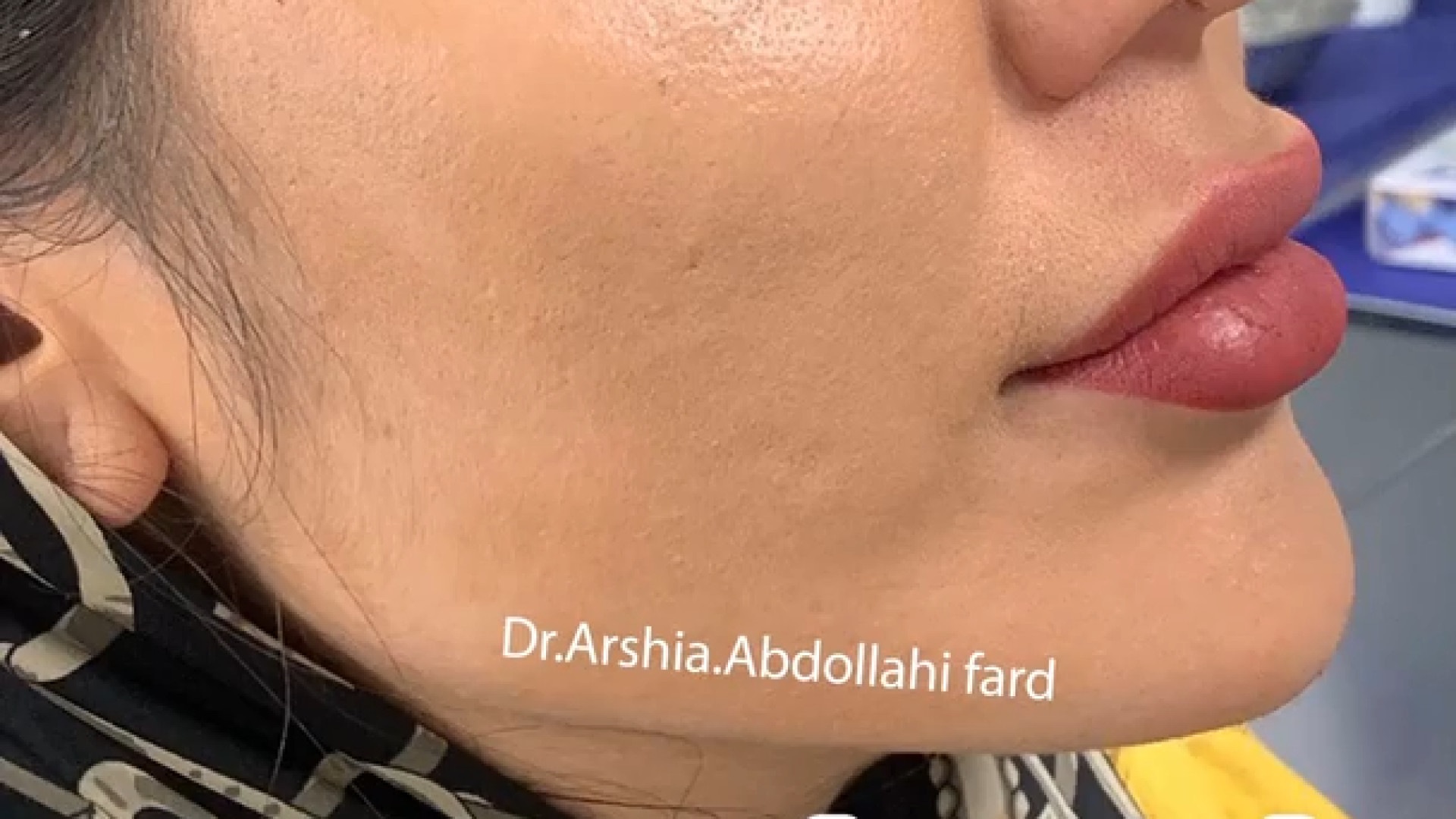 زاویه سازی صورت | دکتر ارشیا عبداللهی فرد پر کردن دندان