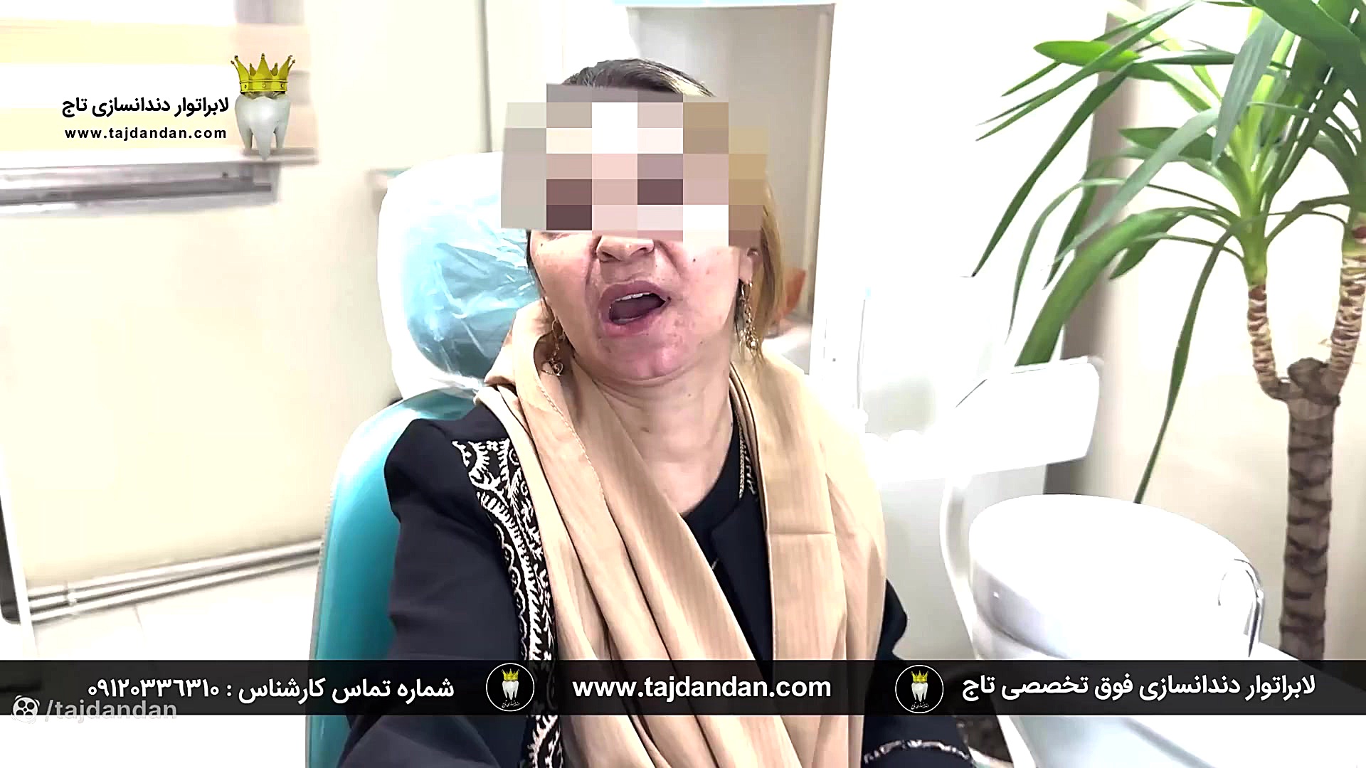 رضایت خانم جوان اهل بروجرد از ساخت پروتز دندان متحرک ایووبیس سوئیسی در تاج دندان درمان سلولیت