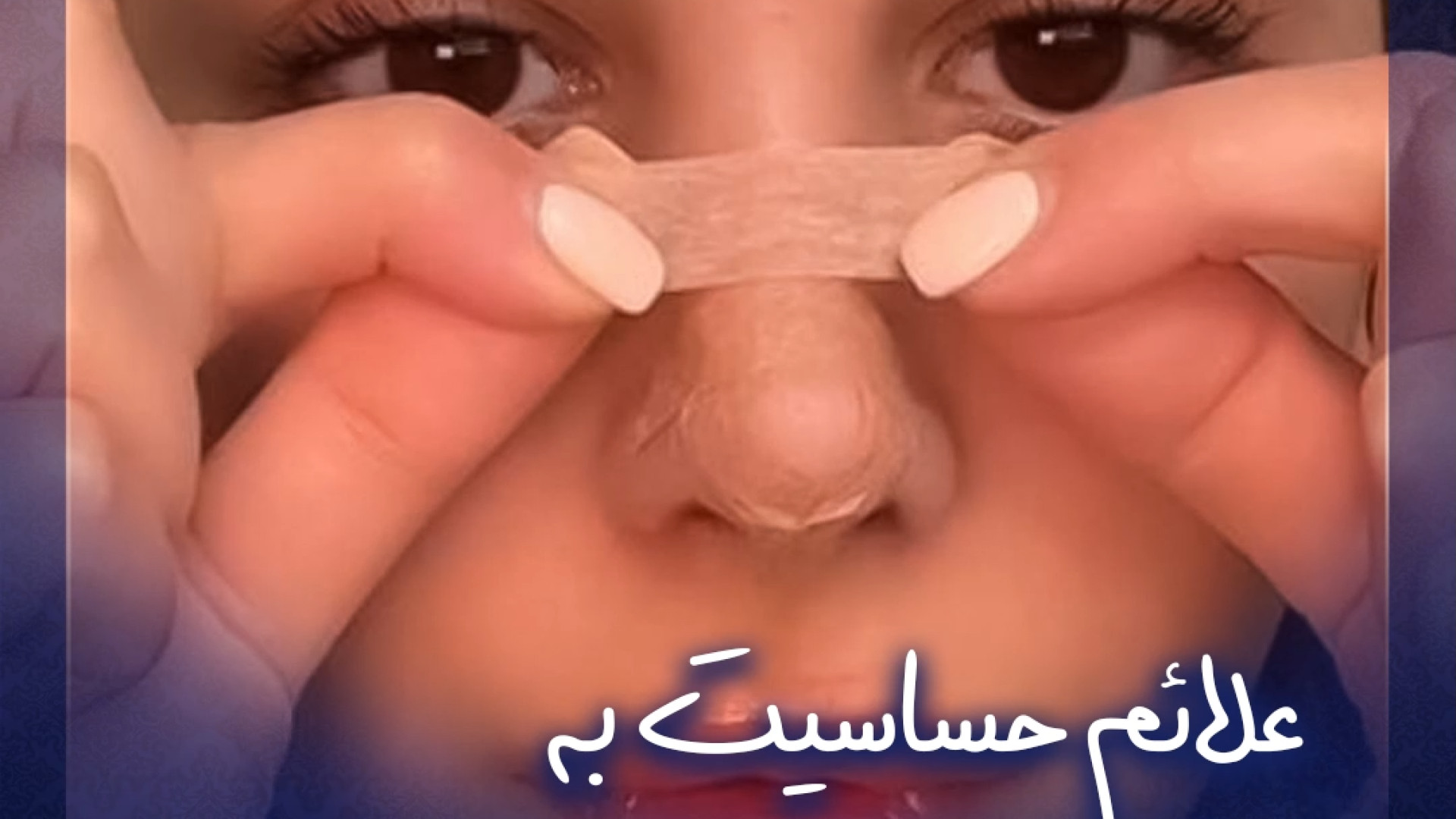 علائم حساسیت به چسب بینی | دکتر نگین نجمی هموکروماتوز