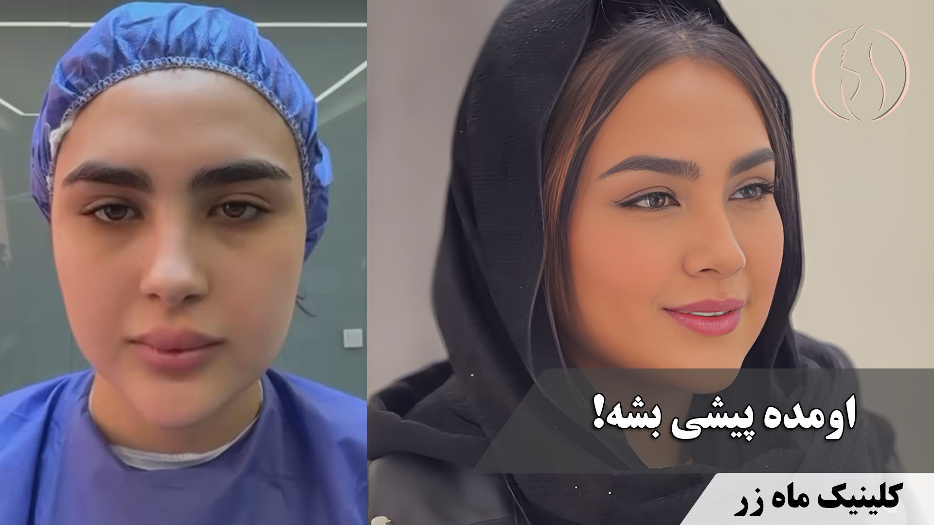 چهره‌ای که جادوی طبیعت را در خود دارد! ( کلینیک زیبایی ماه زر ) بیماری استئوجنز ایمپرفکتا