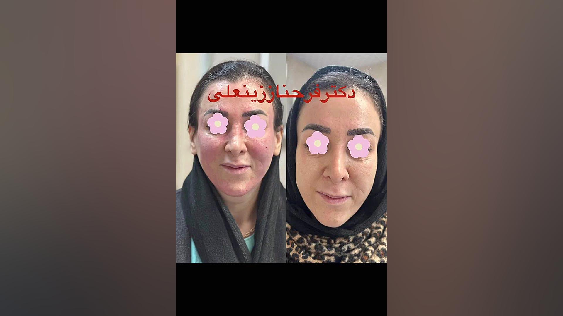 تزریق فقط دو سی سی فیلر دکتر فرحناز زینعلی - متخصص پوست، مو، زیبایی زنجان