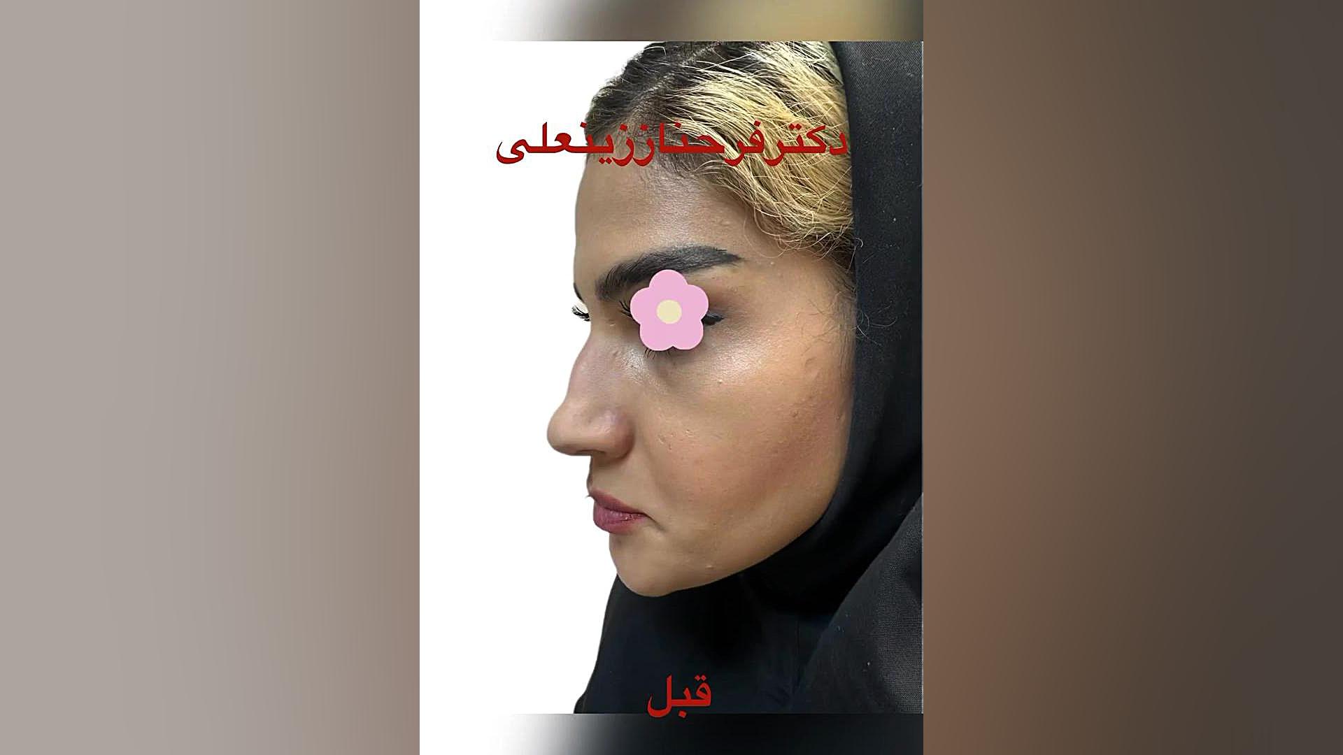 تزریق کمتر از یک سی سی فیلر به بینی دکتر فرحناز زینعلی - متخصص پوست، مو، زیبایی زنجان