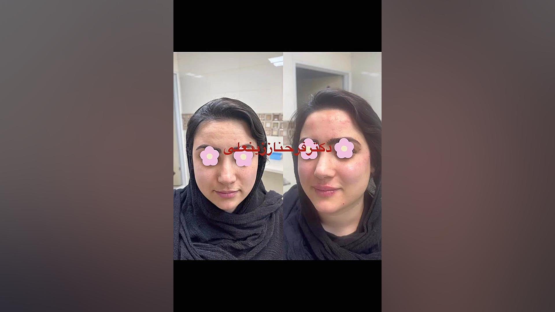 تزریق فیلر صورت و ژل لب با متد MDcode دکتر فرحناز زینعلی - متخصص پوست، مو، زیبایی زنجان