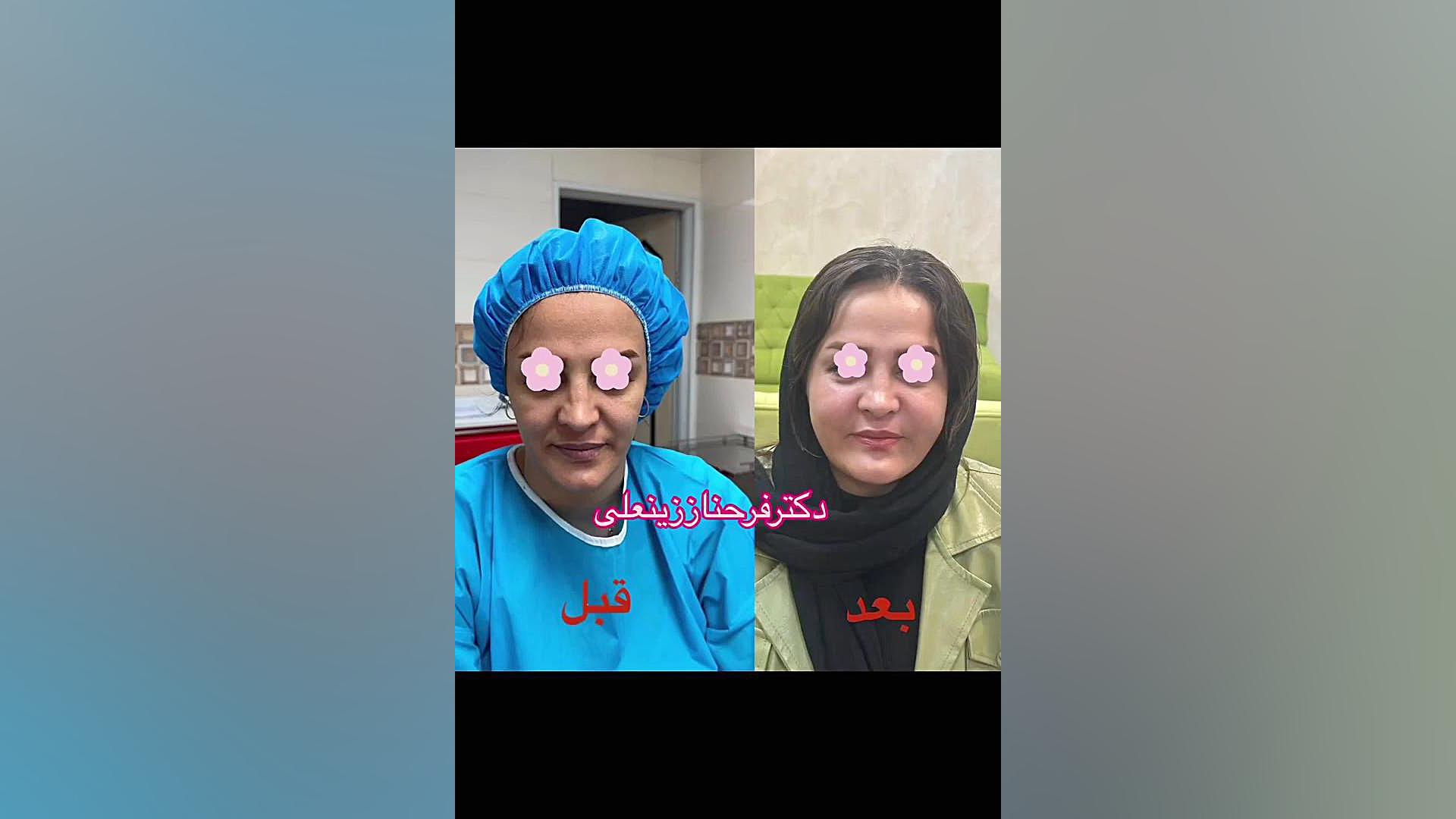جوانی دوباره با تزریق چربی توسط دکترفرحناززینعلی دکتر فرحناز زینعلی - متخصص پوست، مو، زیبایی زنجان