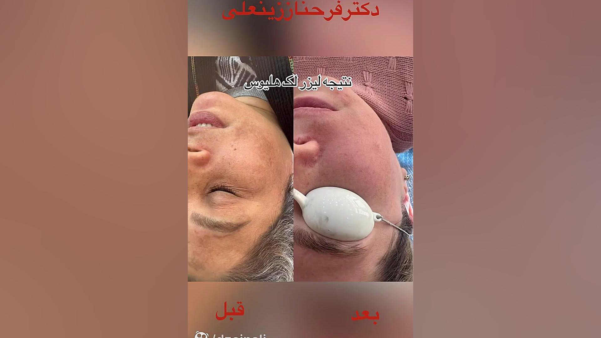 نتیجه یک جلسه لیزر لک هلیوس سه برای از بین بردن لک دکتر فرحناز زینعلی - متخصص پوست، مو، زیبایی زنجان