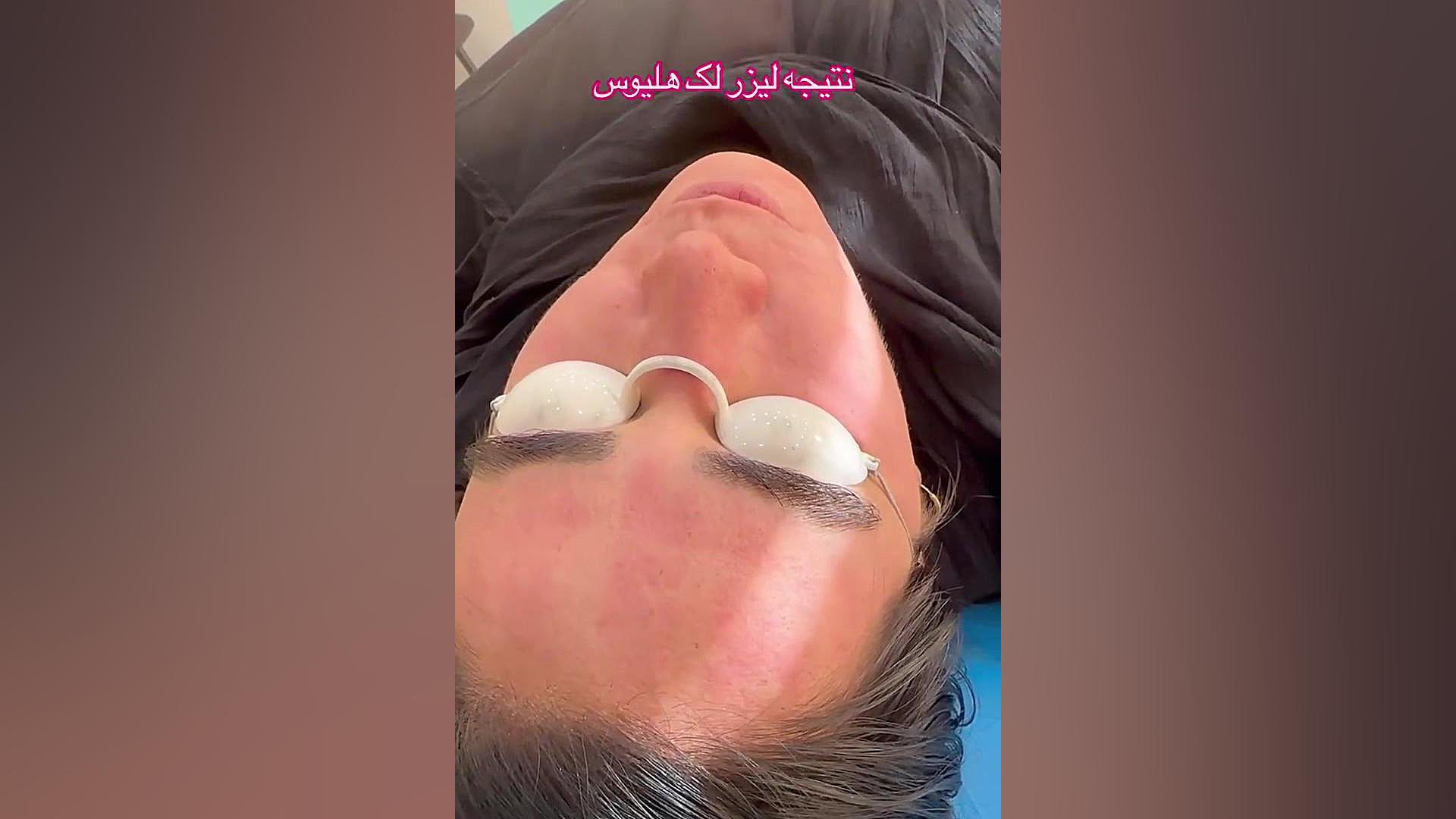 نتیجه یک جلسه لیزر لک هلیوس سه برای لک صورت دکتر فرحناز زینعلی - متخصص پوست، مو، زیبایی زنجان