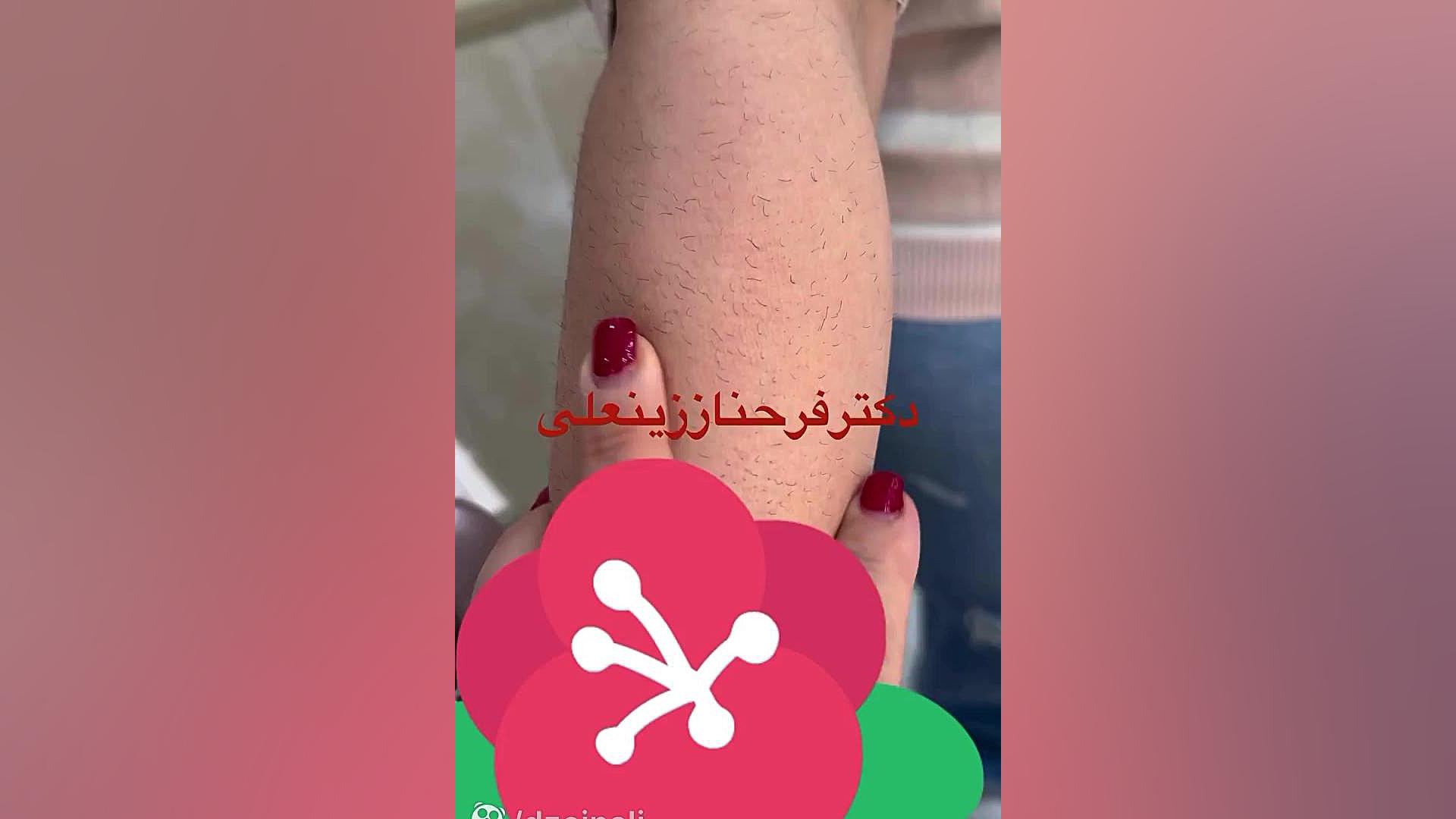 نکاتی مهم درمورد لیزرهای موی زاید دکتر فرحناز زینعلی - متخصص پوست، مو، زیبایی زنجان