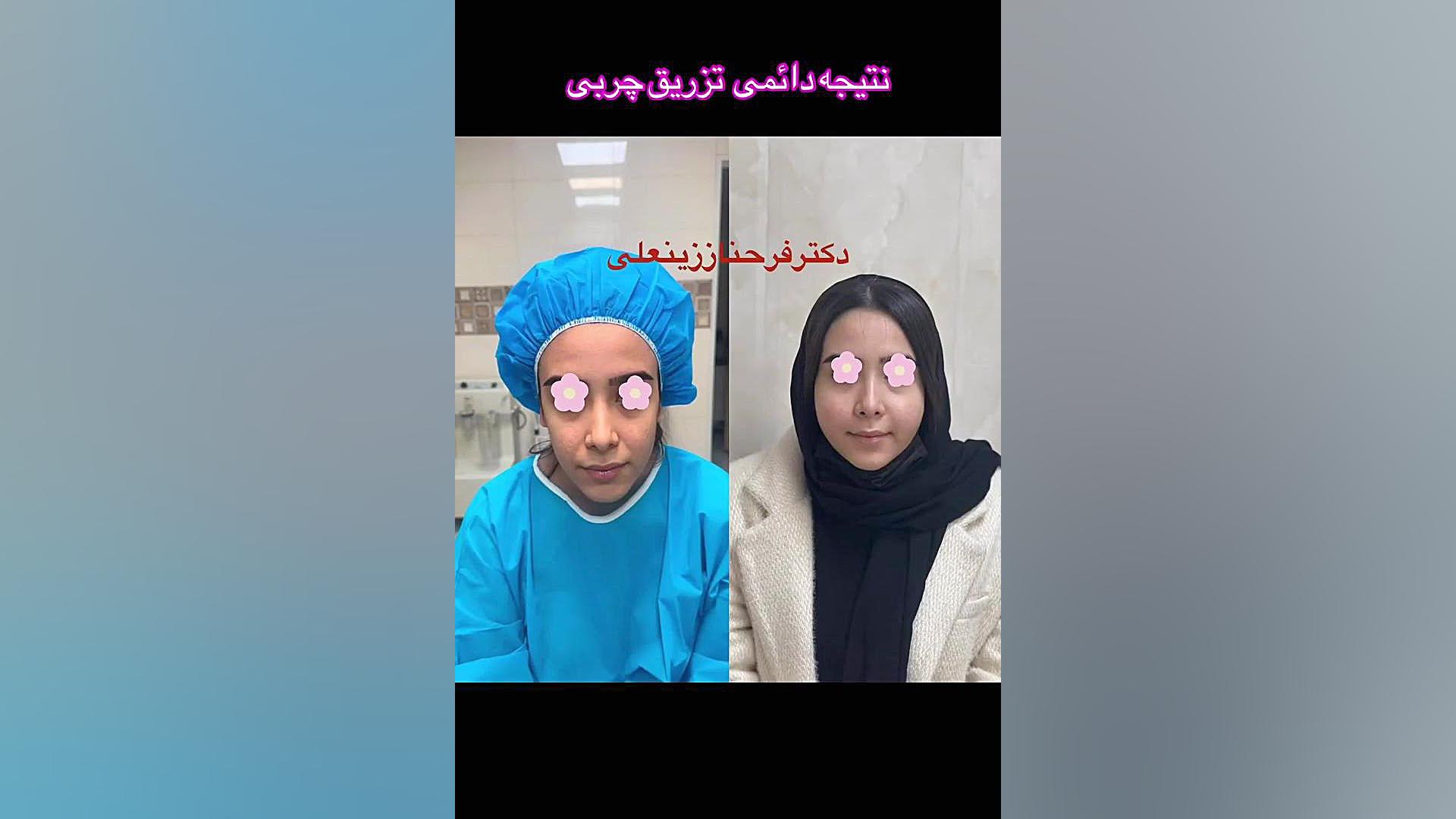 ریمادلینگ ماندگاری صورت با تزریقات چربی دکتر فرحناز زینعلی - متخصص پوست، مو، زیبایی زنجان