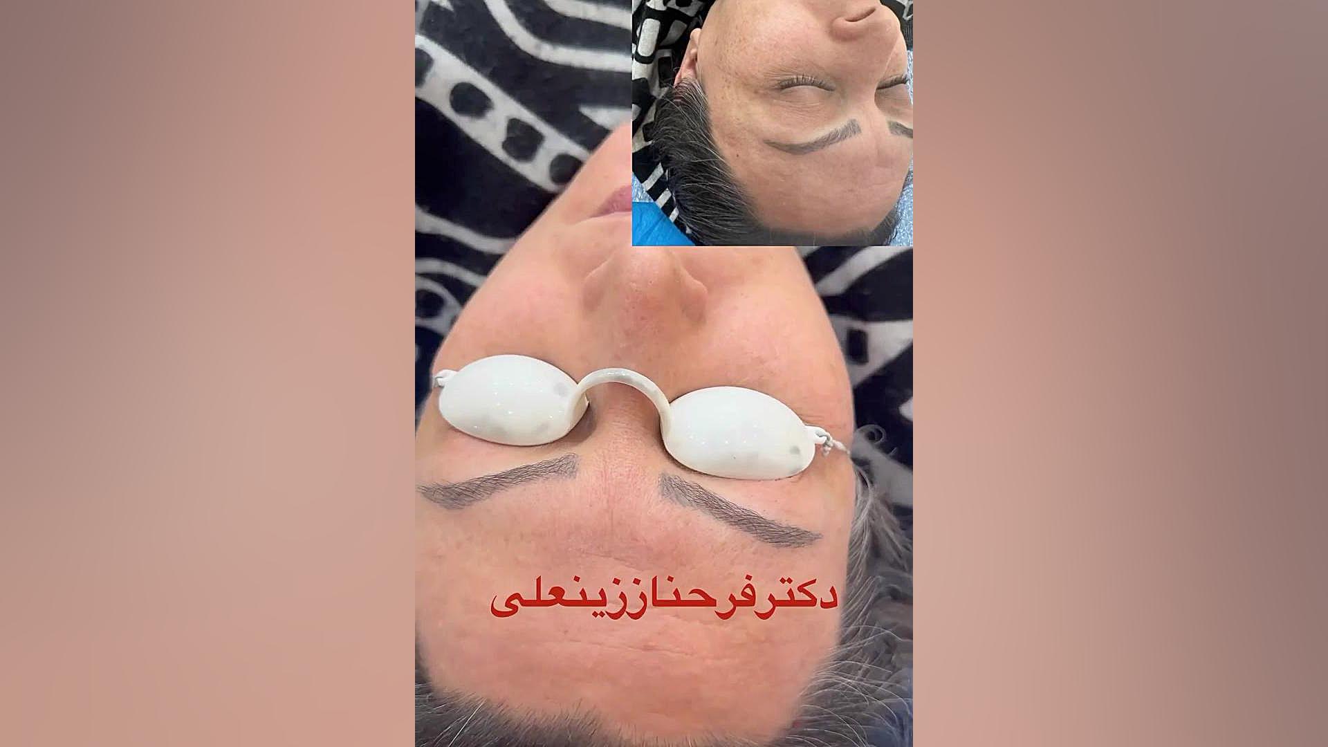 نتیجه یک جلسه لیزر هلیوس ۳ برای رفع لک و کک ومک دکتر فرحناز زینعلی - متخصص پوست، مو، زیبایی زنجان