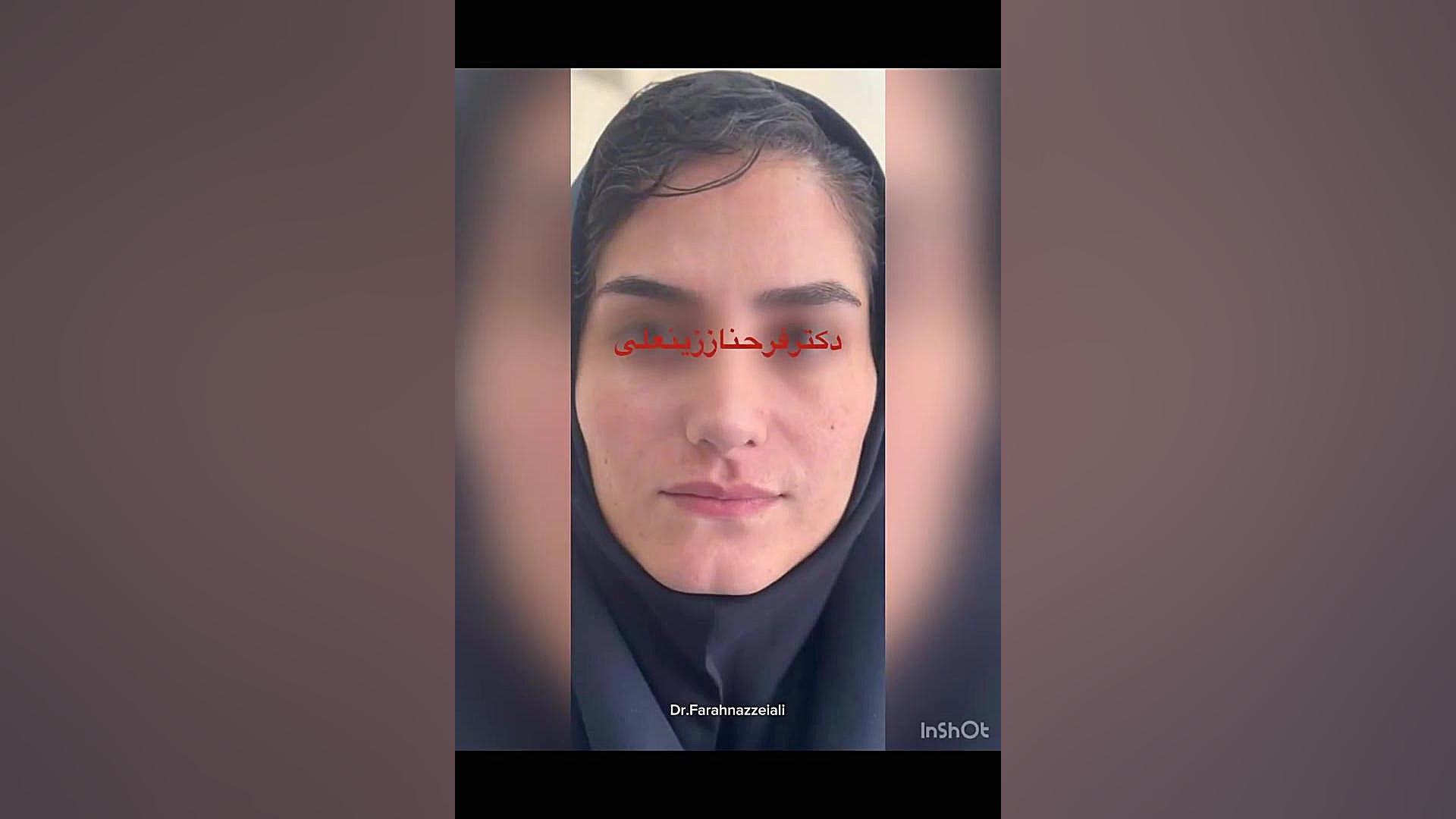 زیبایی و جوانی با تزریق سه سی سی فیلر ناحیه گونه به متد جدید دکتر فرحناز زینعلی - متخصص پوست، مو، زیبایی زنجان