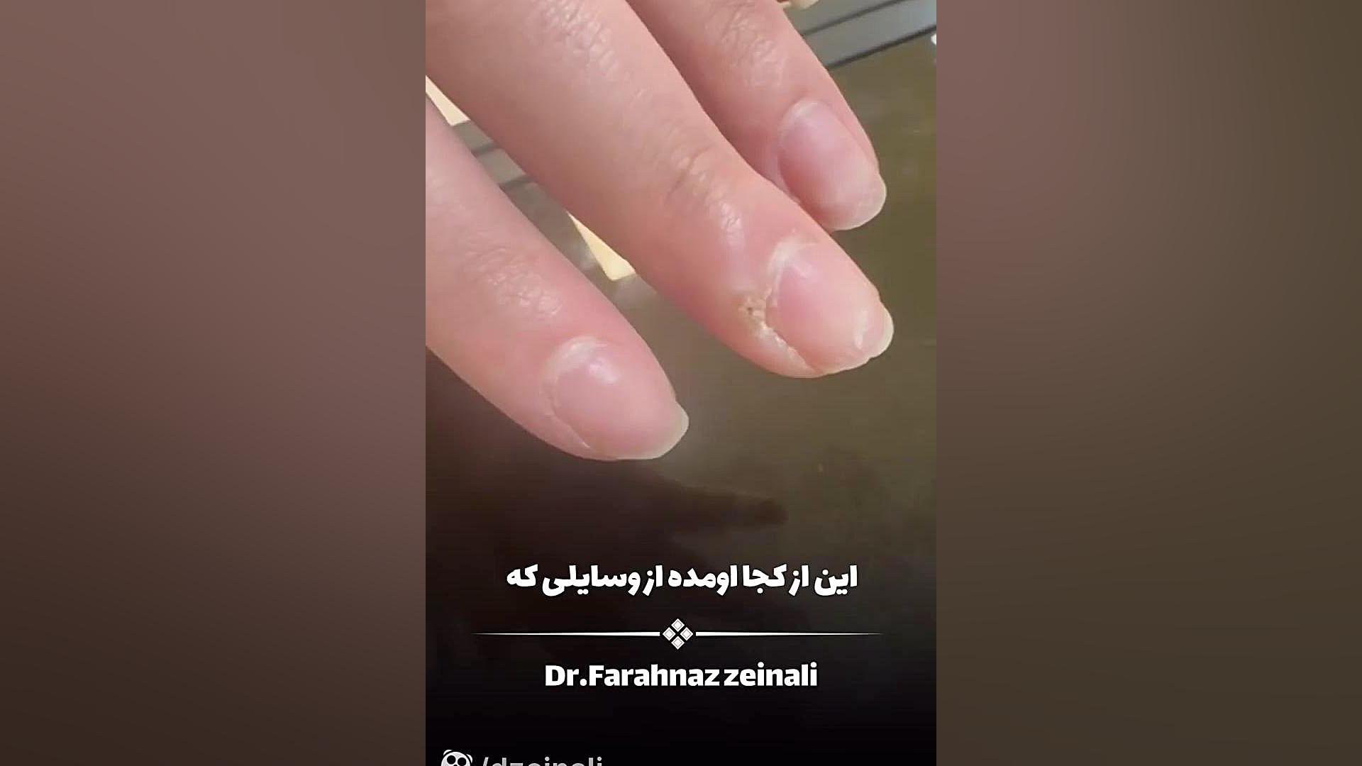 نکات مهمی که قبل از کاشت ناخن باید بدونید دکتر فرحناز زینعلی - متخصص پوست، مو، زیبایی زنجان