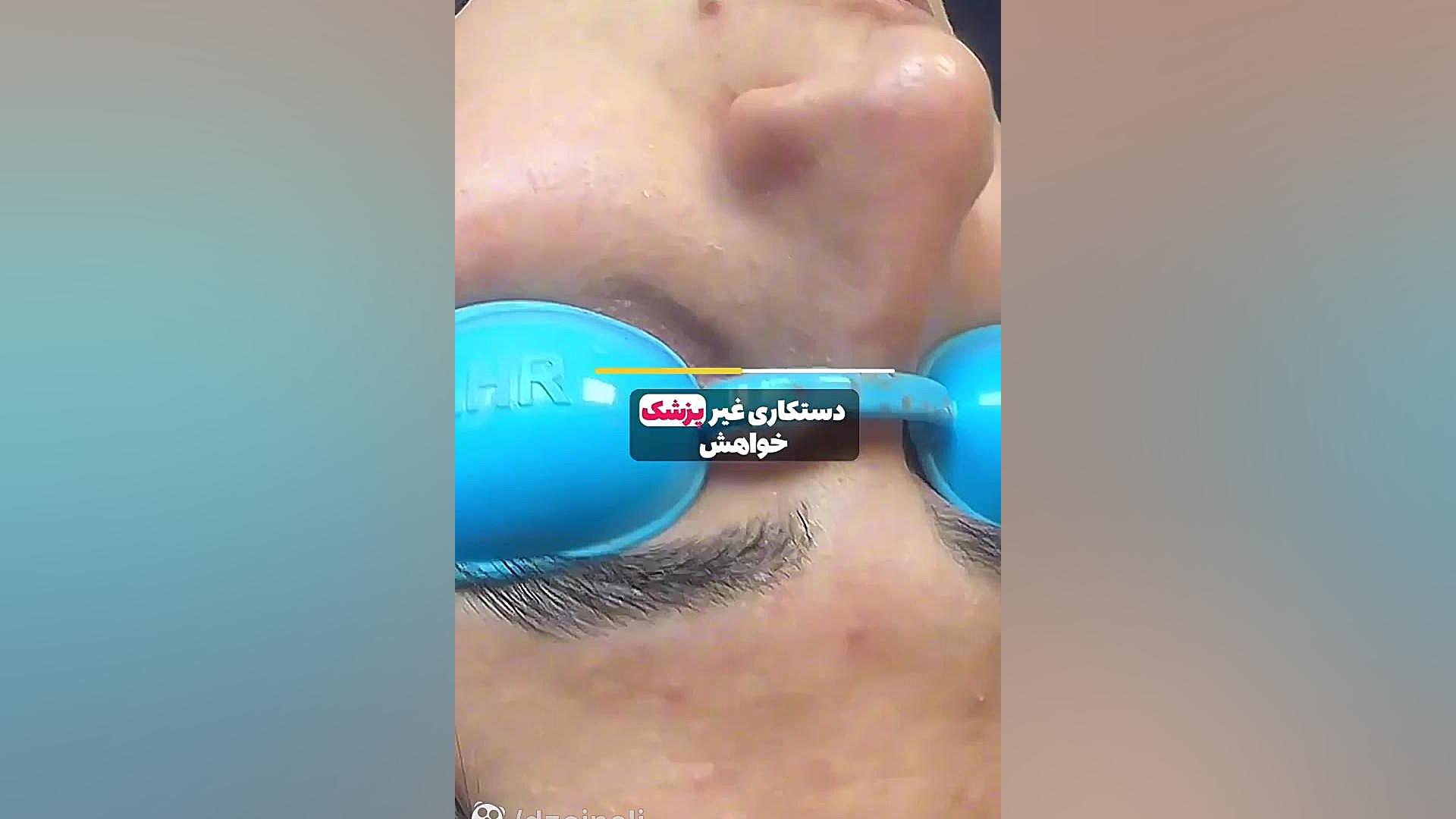 آسیب های زیاد بعد از انجام فشیال دکتر فرحناز زینعلی - متخصص پوست، مو، زیبایی زنجان
