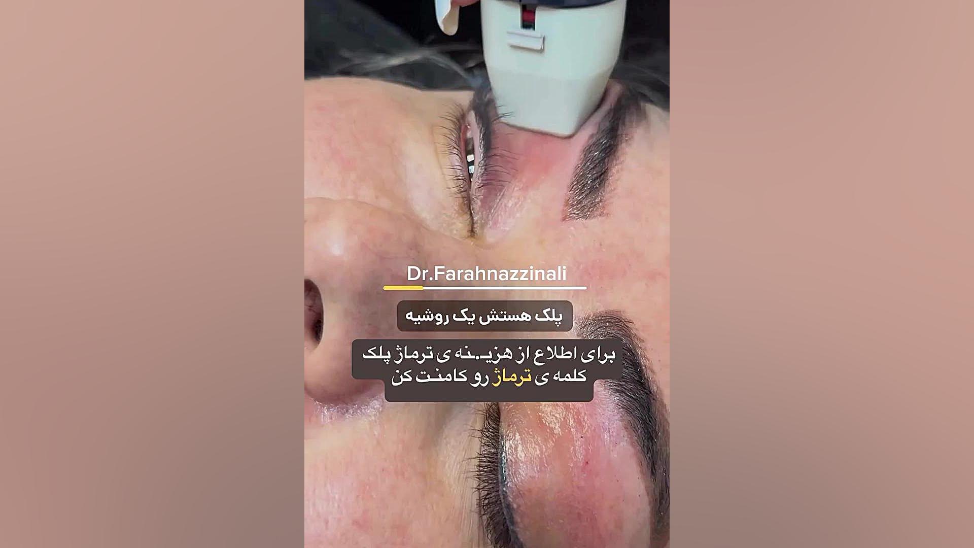 ترماژ پلک دکتر فرحناز زینعلی - متخصص پوست، مو، زیبایی زنجان