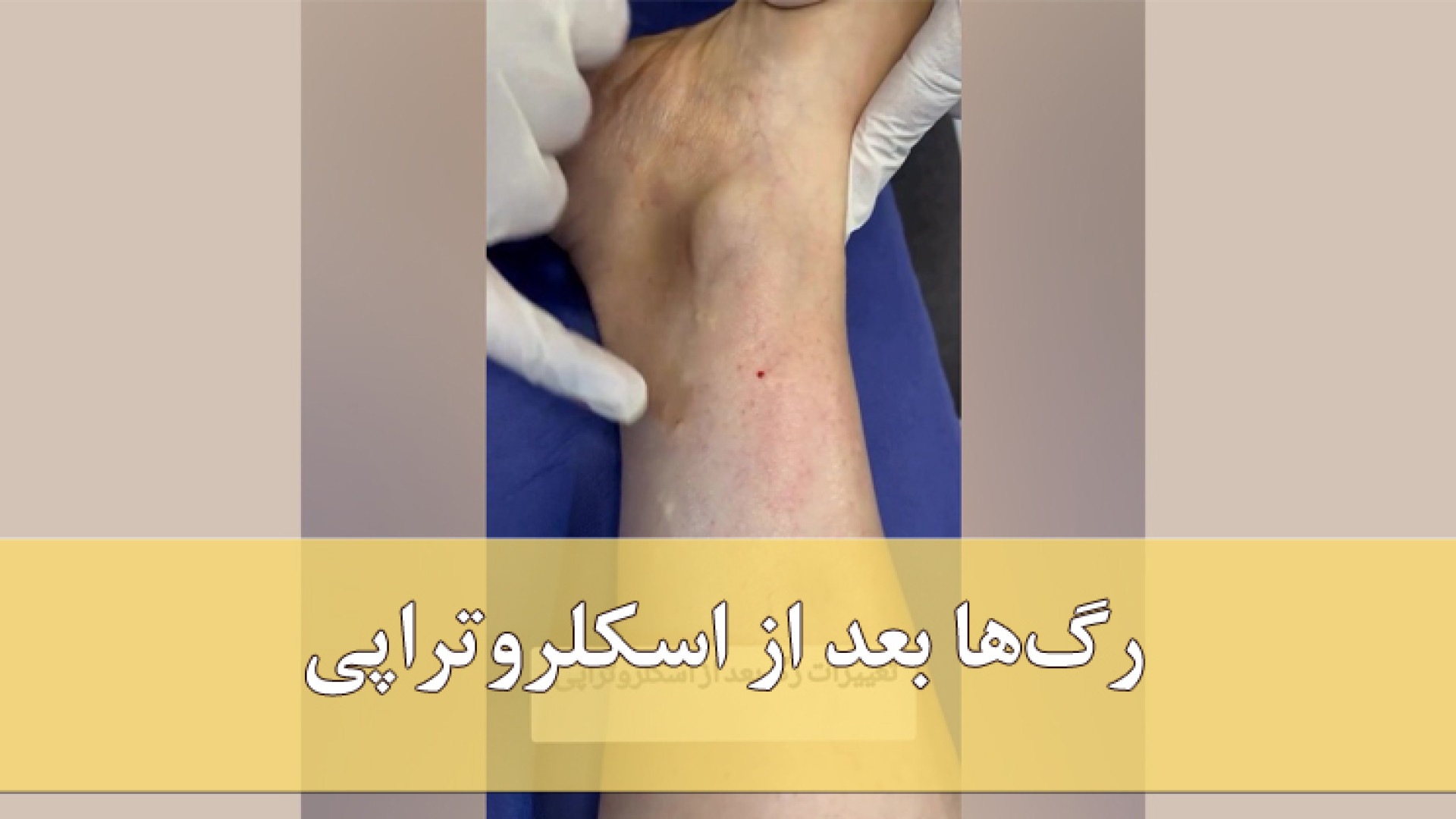 رگ ها بعد از اسکلروتراپی دکتر مهدی کریمی