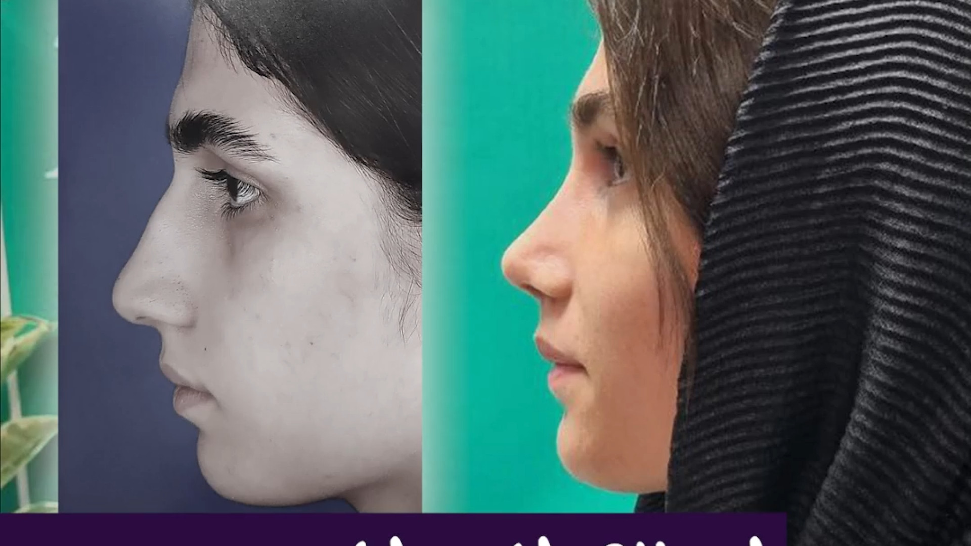 اصلاح انحراف بینی | دکتر علی حسینی واجاری دکتر علی حسینی واجاری - جراح بینی رشت