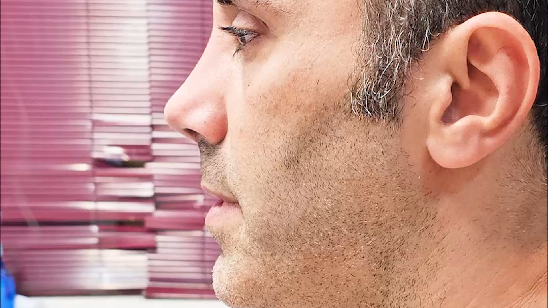 عمل بینی مردانه و طبیعی | دکتر علی حسینی واجاری دکتر علی حسینی واجاری - جراح بینی رشت