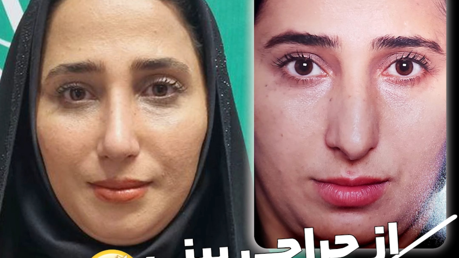رینوپلاستی با دکتر علی حسینی واجاری دکتر علی حسینی واجاری - جراح بینی رشت
