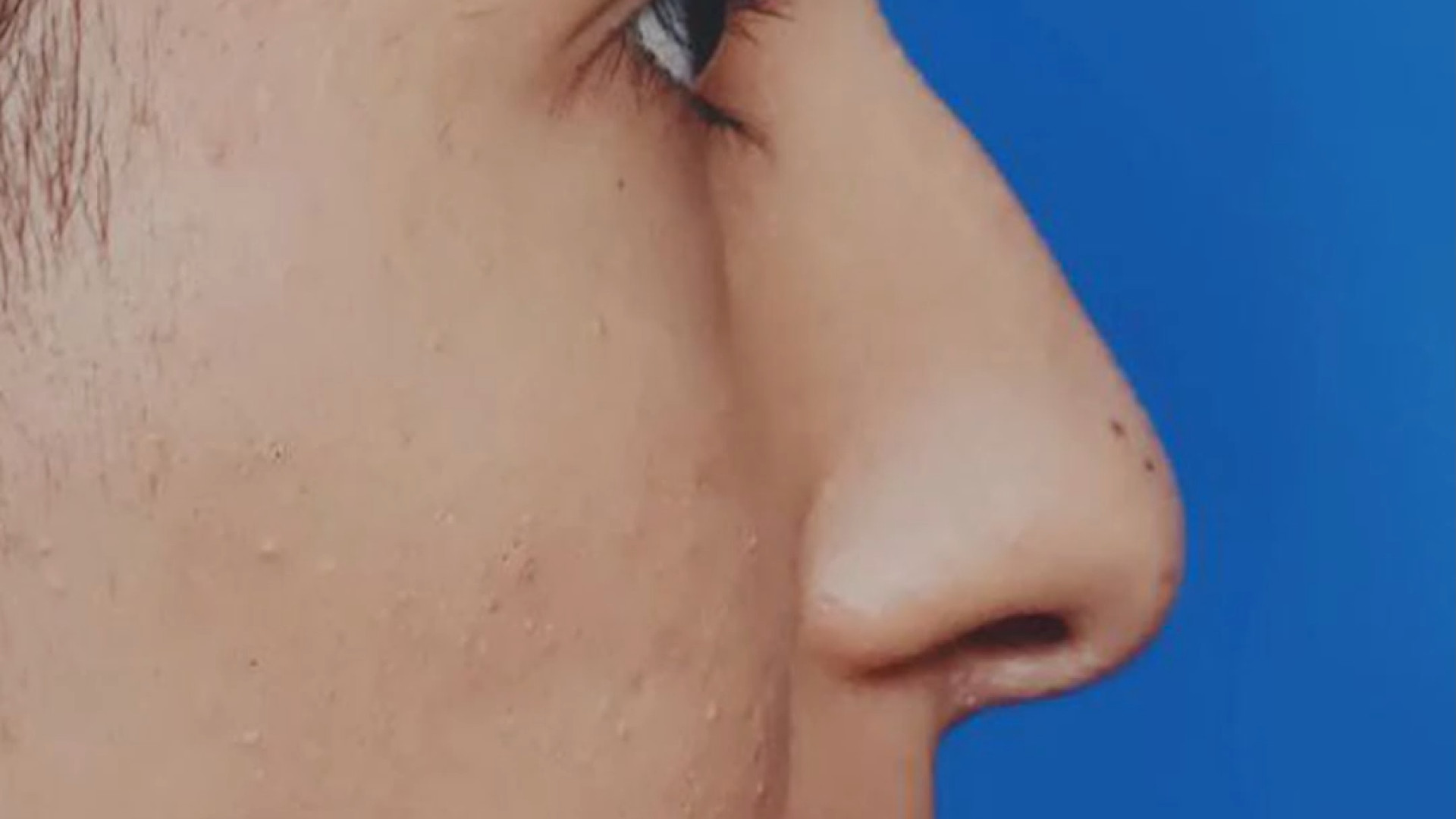 یک ماه بعد از جراحی بینی قوزدار | دکتر علی حسینی واجاری دکتر علی حسینی واجاری - جراح بینی رشت