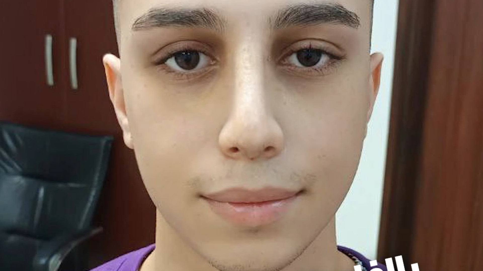 بلافاصله بعد از برداشتن گچ بینی | دکتر علی حسینی واجاری دکتر علی حسینی واجاری - جراح بینی رشت