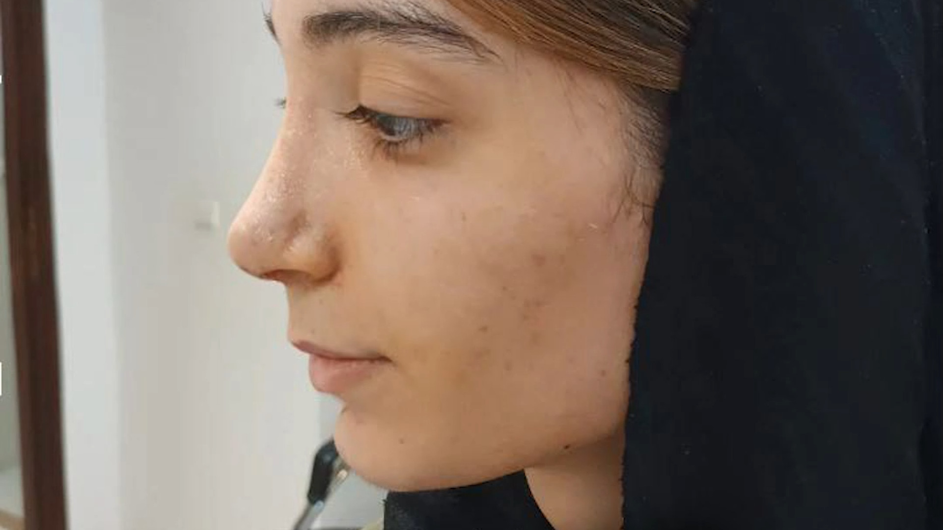 بلافاصله بعد از کشیدن بخیه بینی | دکتر علی حسینی واجاری دکتر علی حسینی واجاری - جراح بینی رشت