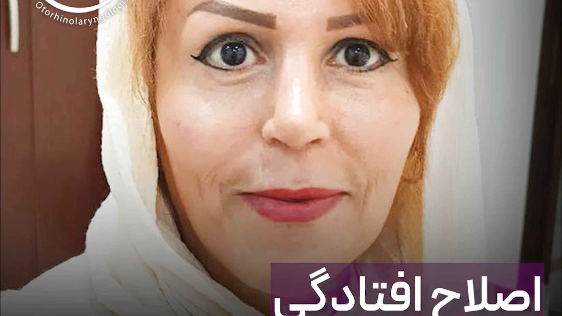 جراحی زیبایی بینی | دکتر علی حسینی واجاری دکتر علی حسینی واجاری - جراح بینی رشت