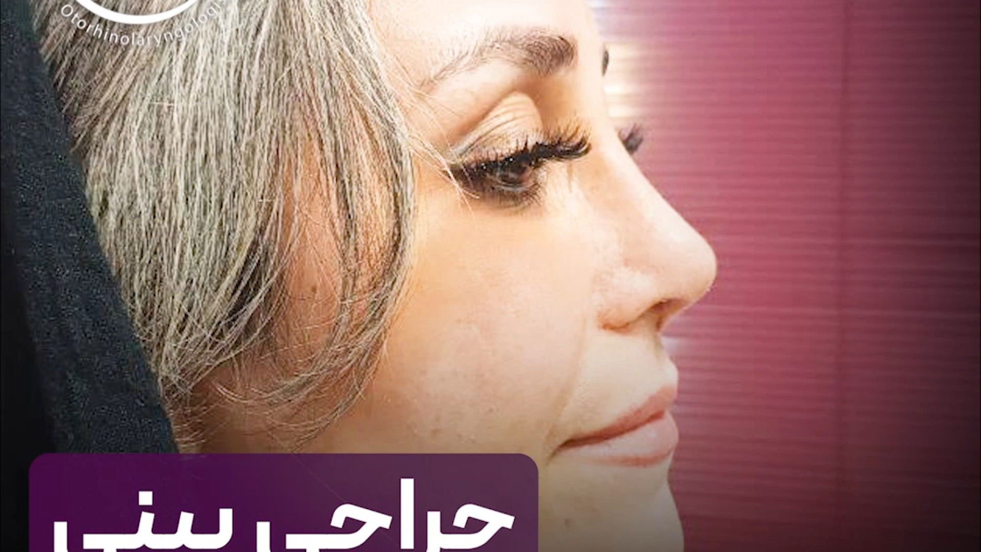 جراحی بینی طبیعی | دکتر علی حسینی واجاری دکتر علی حسینی واجاری - جراح بینی رشت