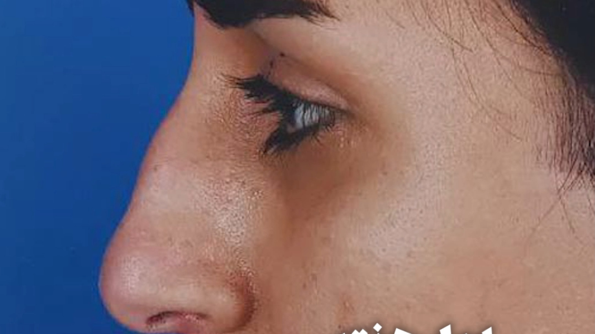 سه هفته بعد از جراحی زیبایی بینی | دکتر علی حسینی واجاری دکتر علی حسینی واجاری - جراح بینی رشت