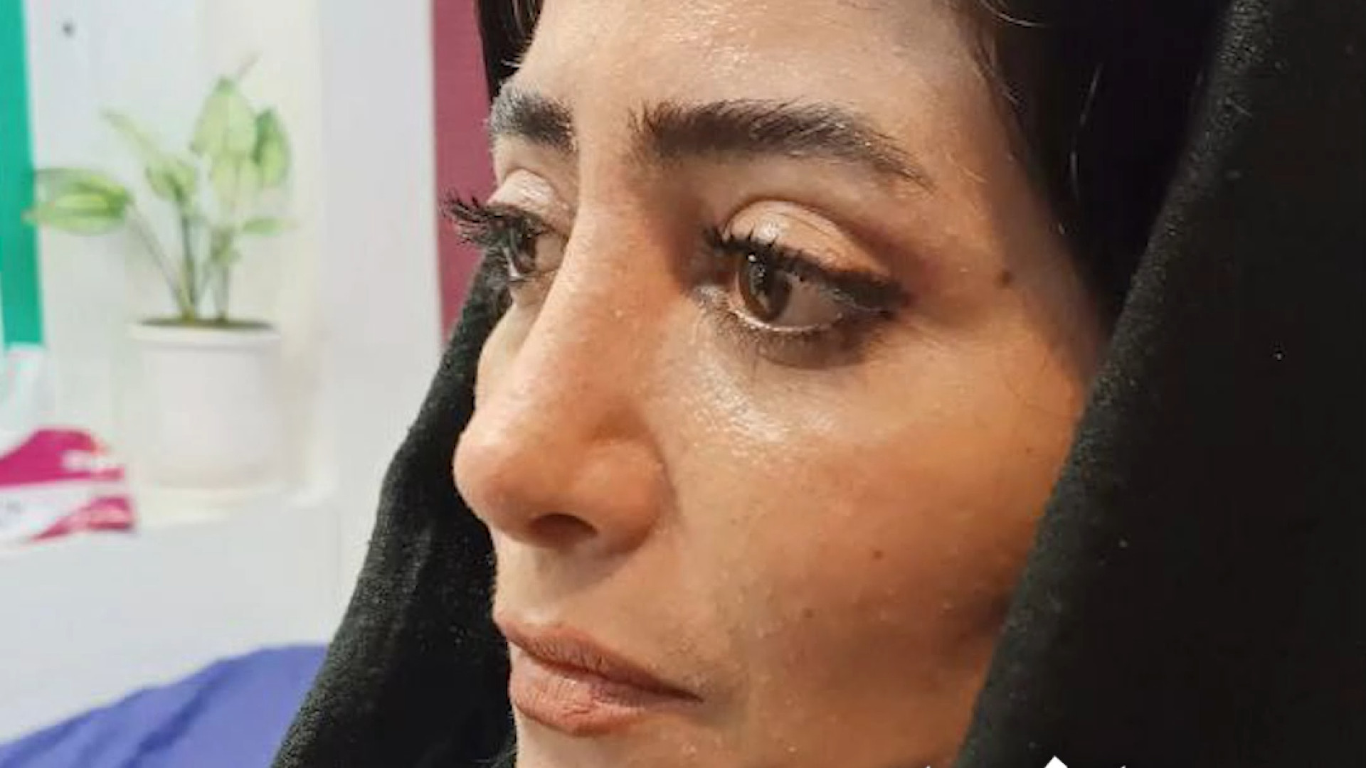 رینوپلاستی و بلفاروپلاستی همزمان | دکتر علی حسینی واجاری دکتر علی حسینی واجاری - جراح بینی رشت