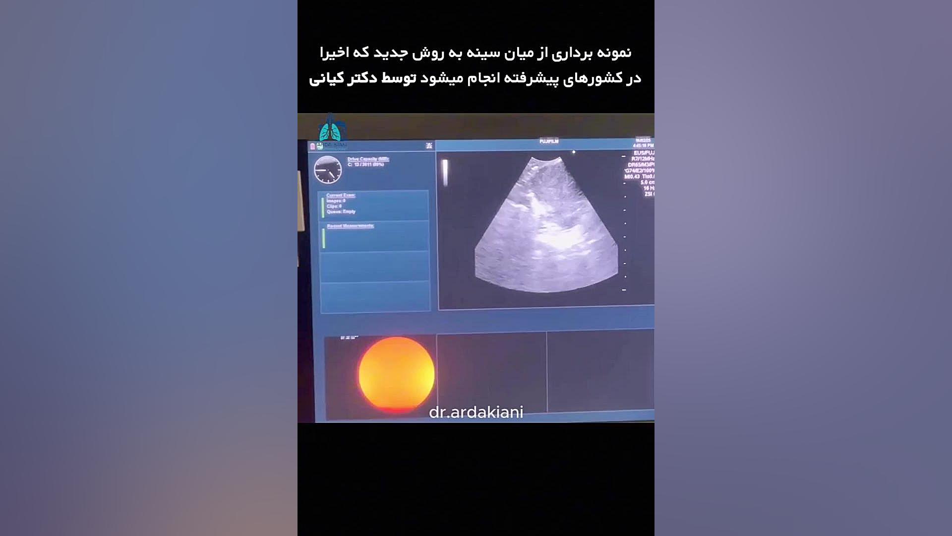 نمونه‌برداری از میان سینه به روش جدید دکتر اردا کیانی